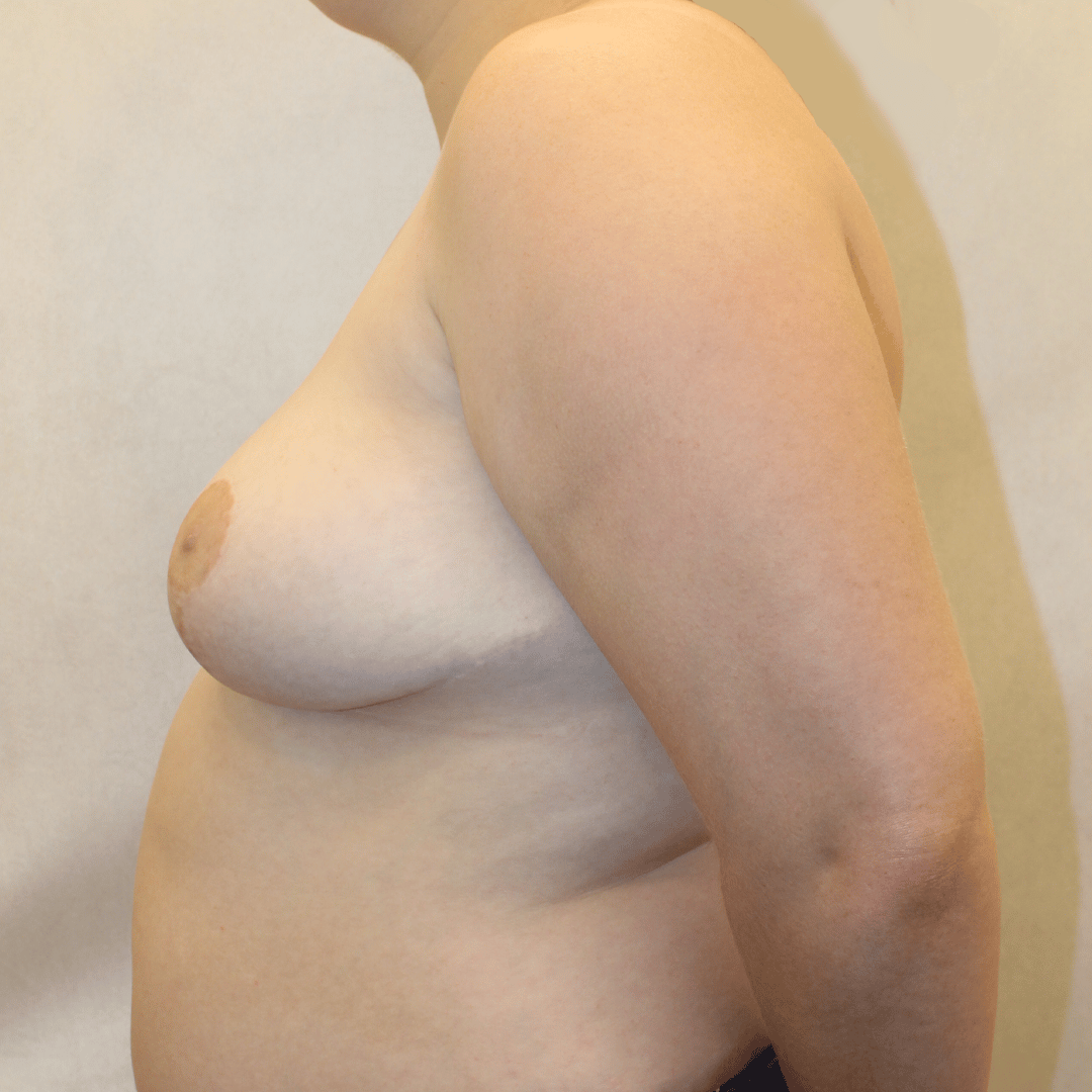 After Image:  - left-side