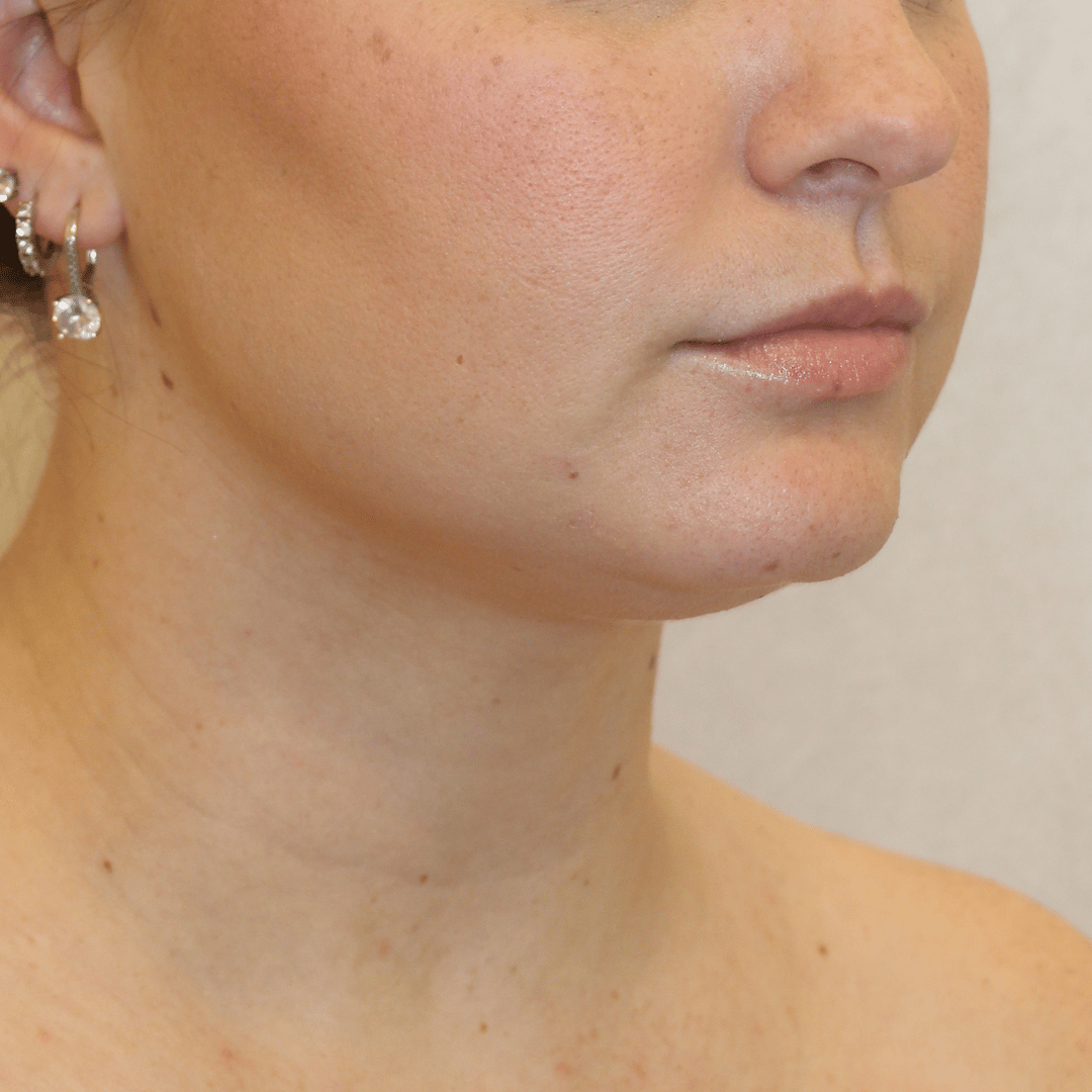 Before Image:  - right-front-oblique
