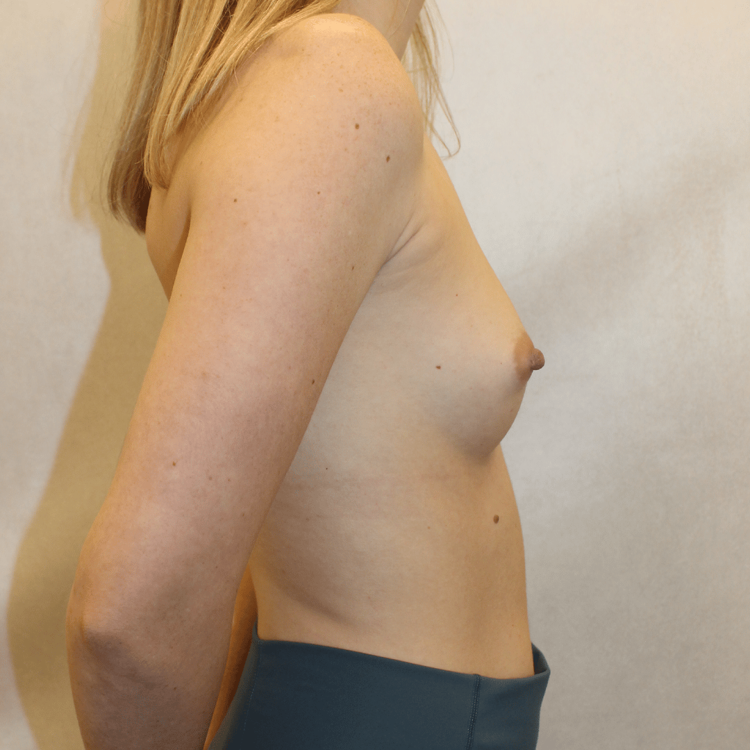 Before Image:  - right-side