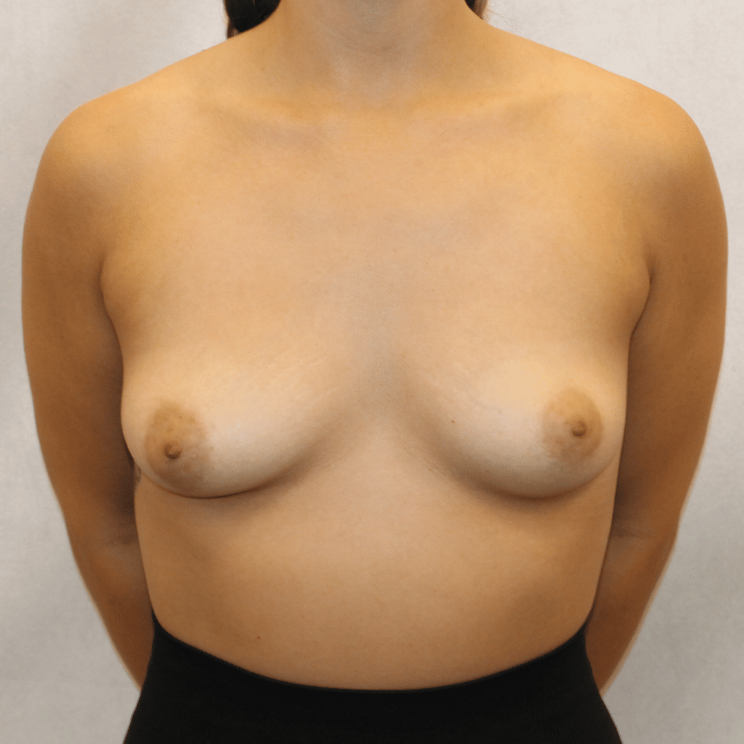Before Image:  - front