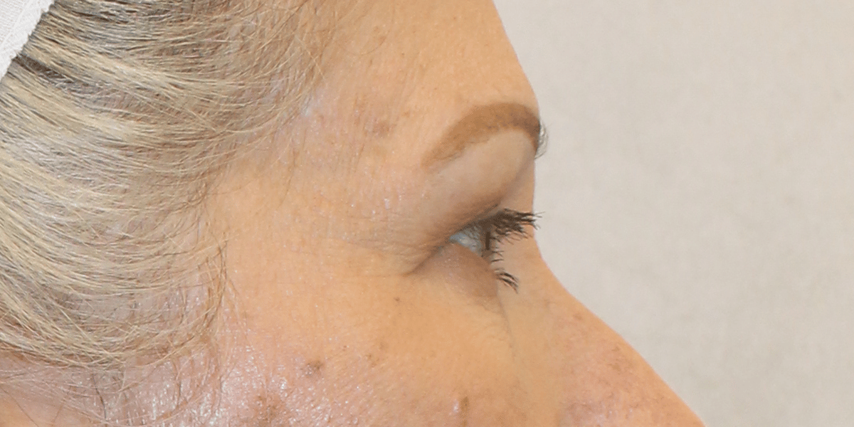 Before Image:  - right-side