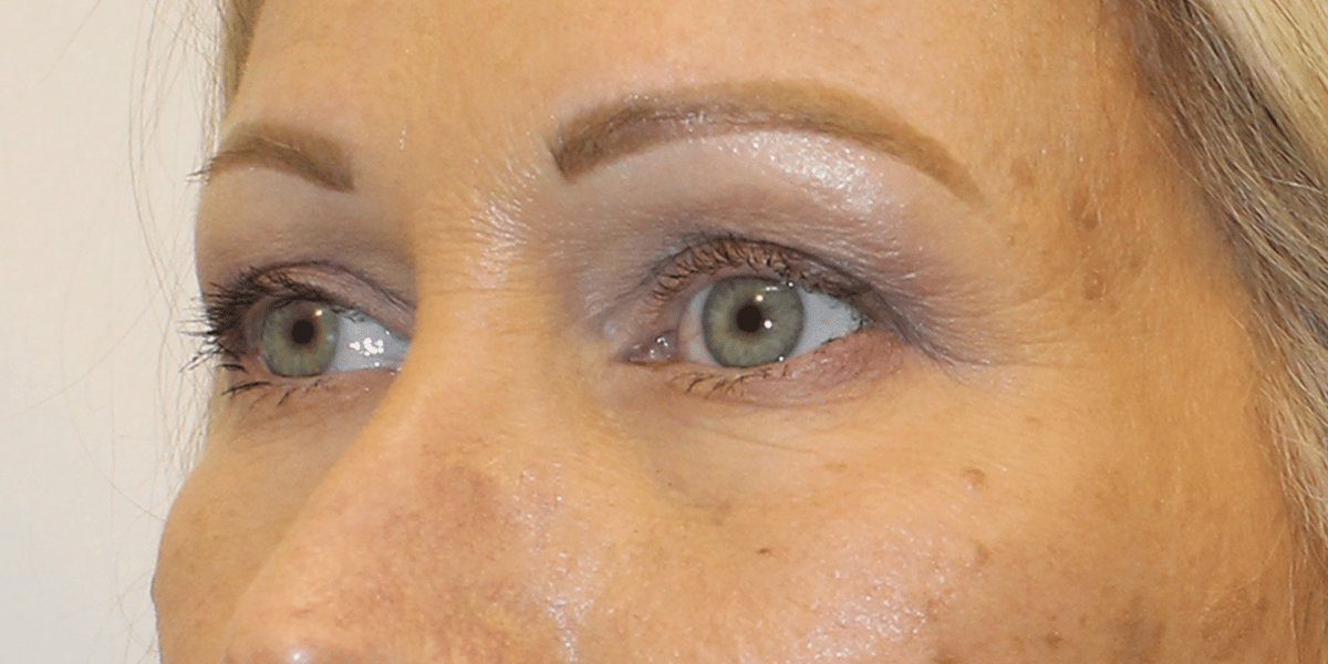 After Image:  - left-front-oblique