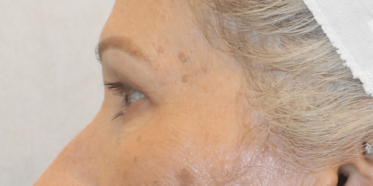 Before Image:  - left-side