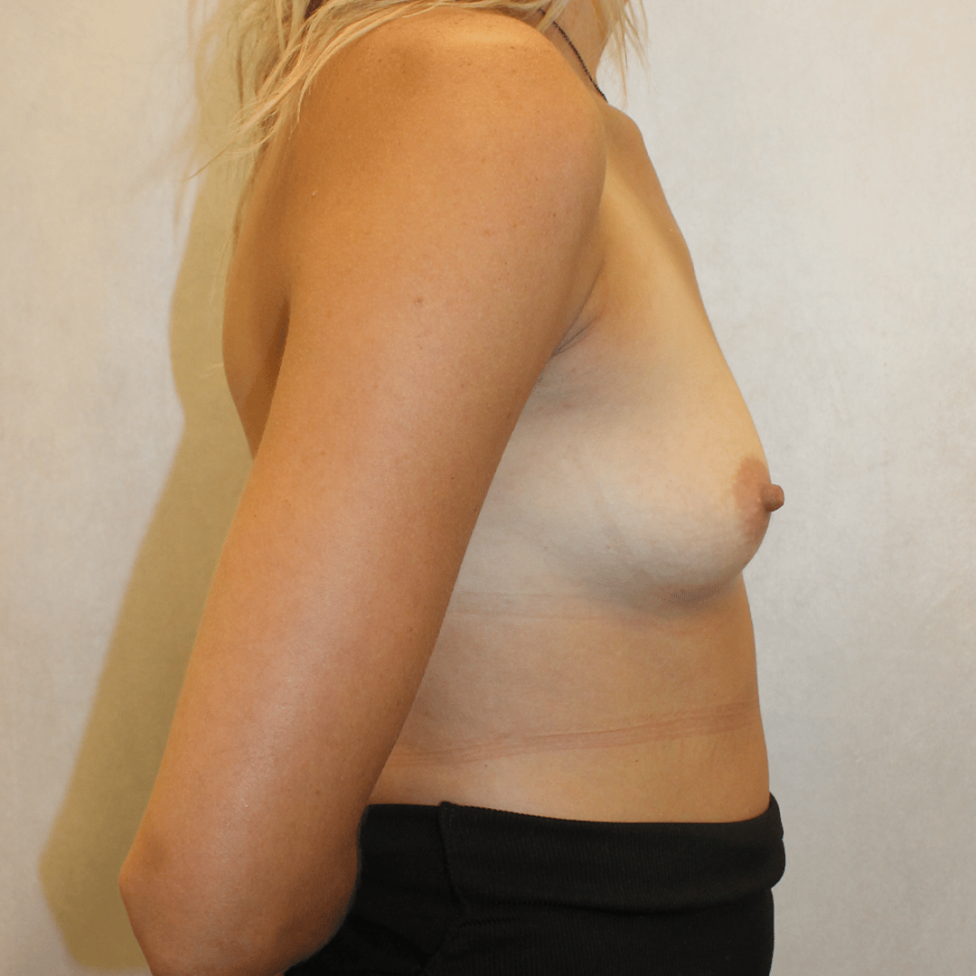Before Image:  - right-side