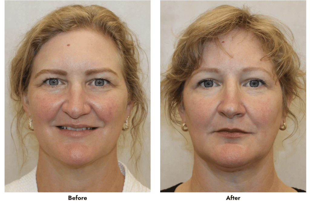 Brow Lift Gainesville FL Forehead Lift Procedure Florida