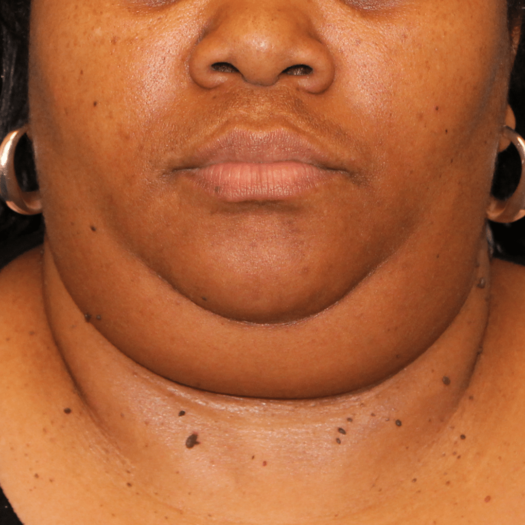 Before Image:  - front