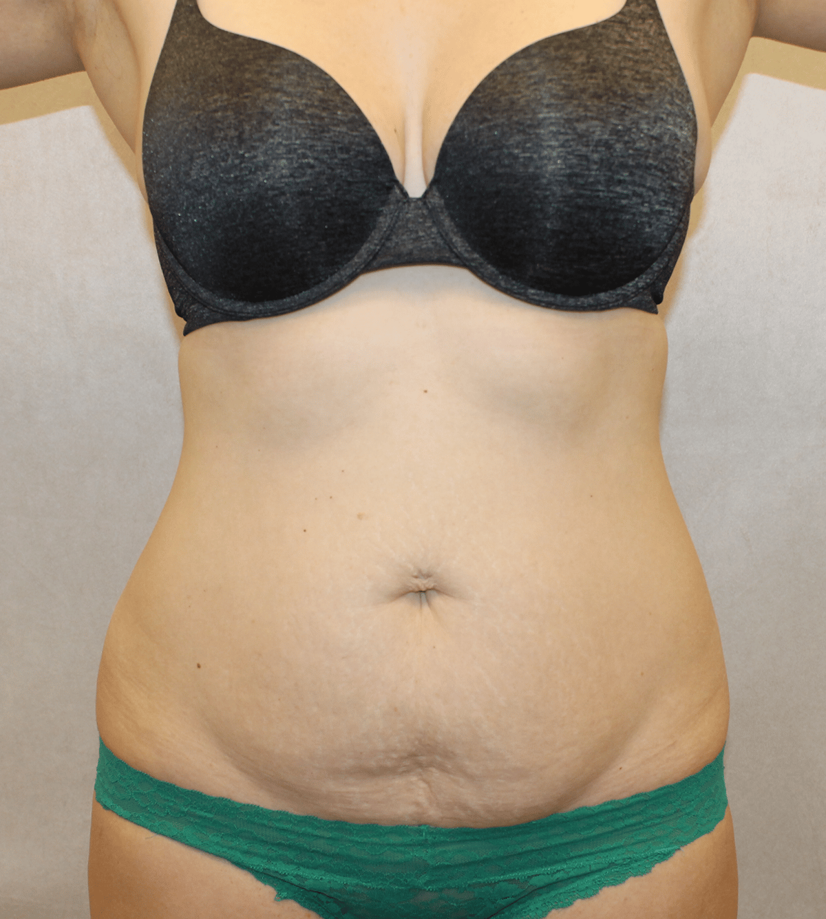 Before Image:  - front