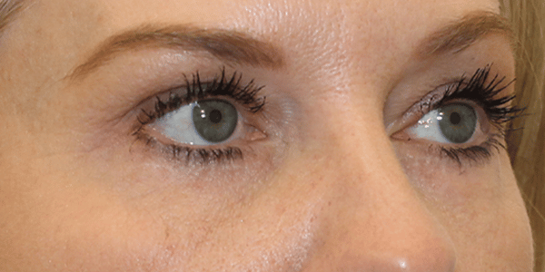 After Image:  - right-front-oblique