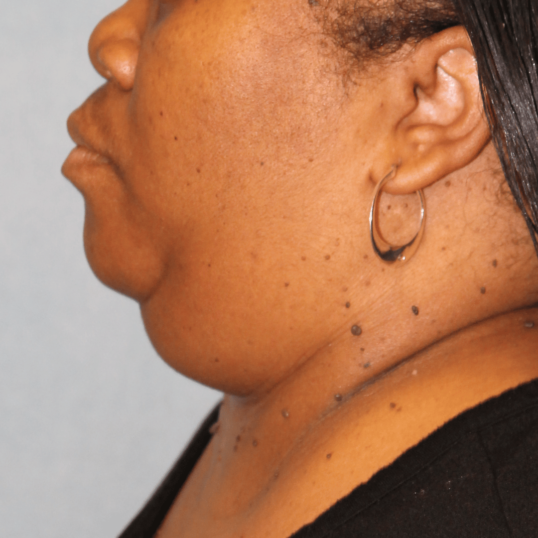 Before Image:  - left-side