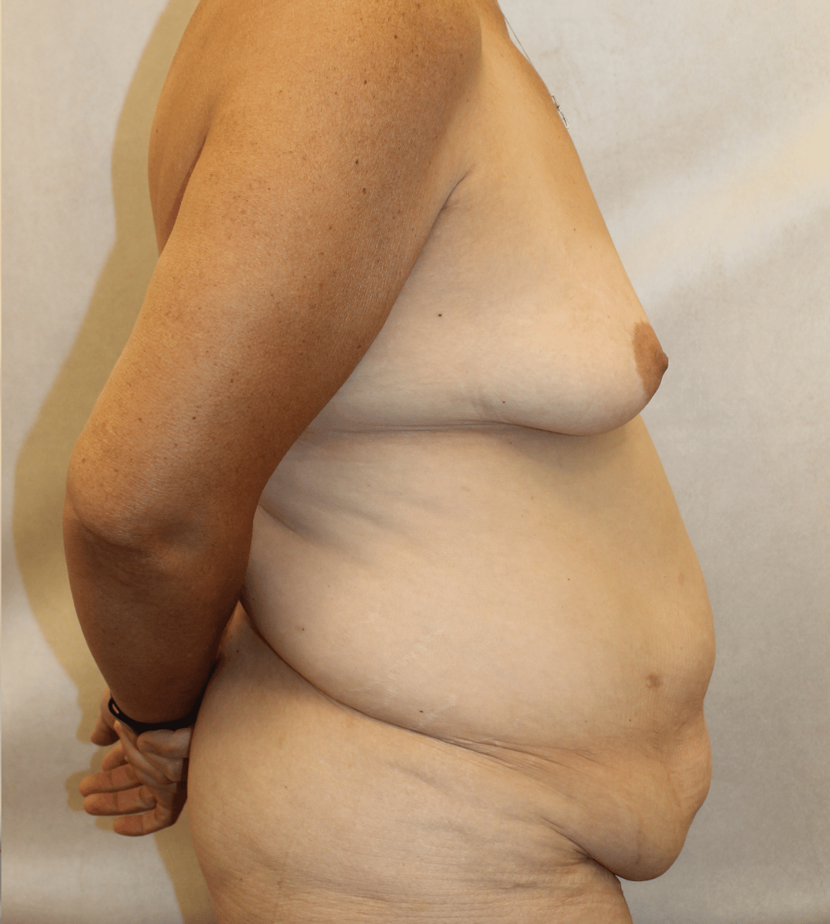 Before Image:  - right-side