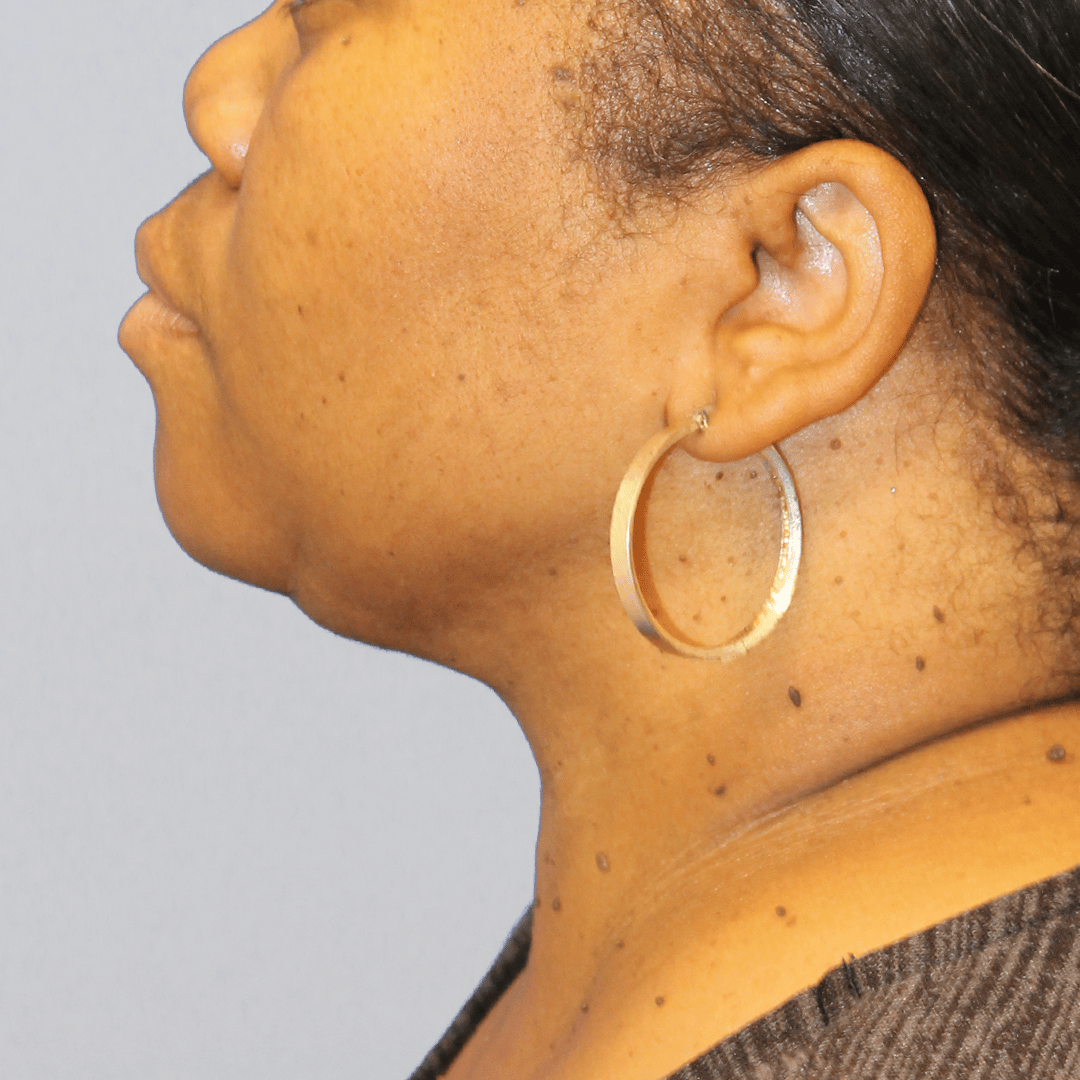 After Image:  - left-side
