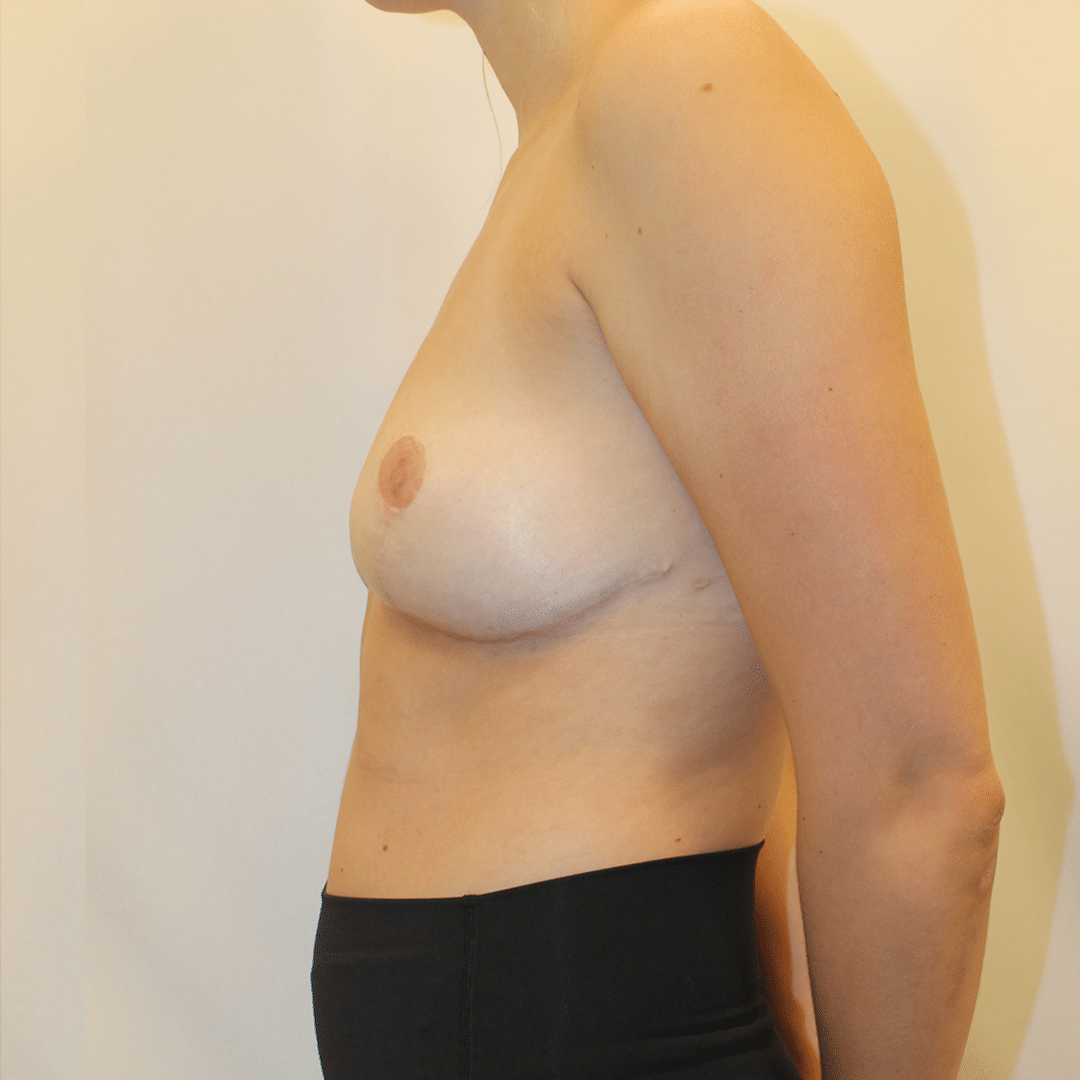 After Image:  - left-side