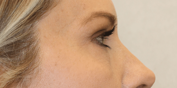 Before Image:  - right-side