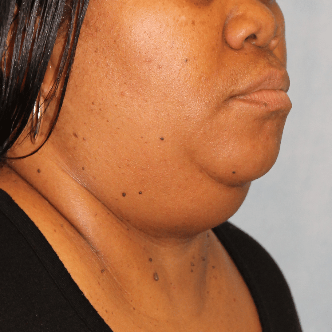 Before Image:  - right-front-oblique
