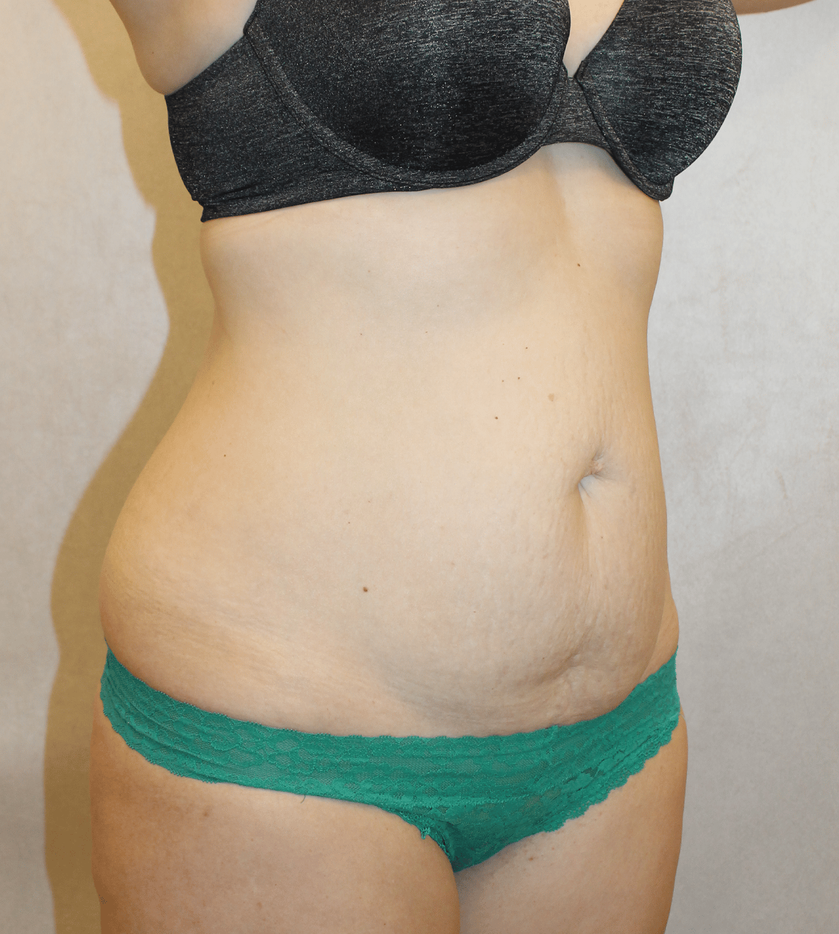 Before Image:  - right-front-oblique