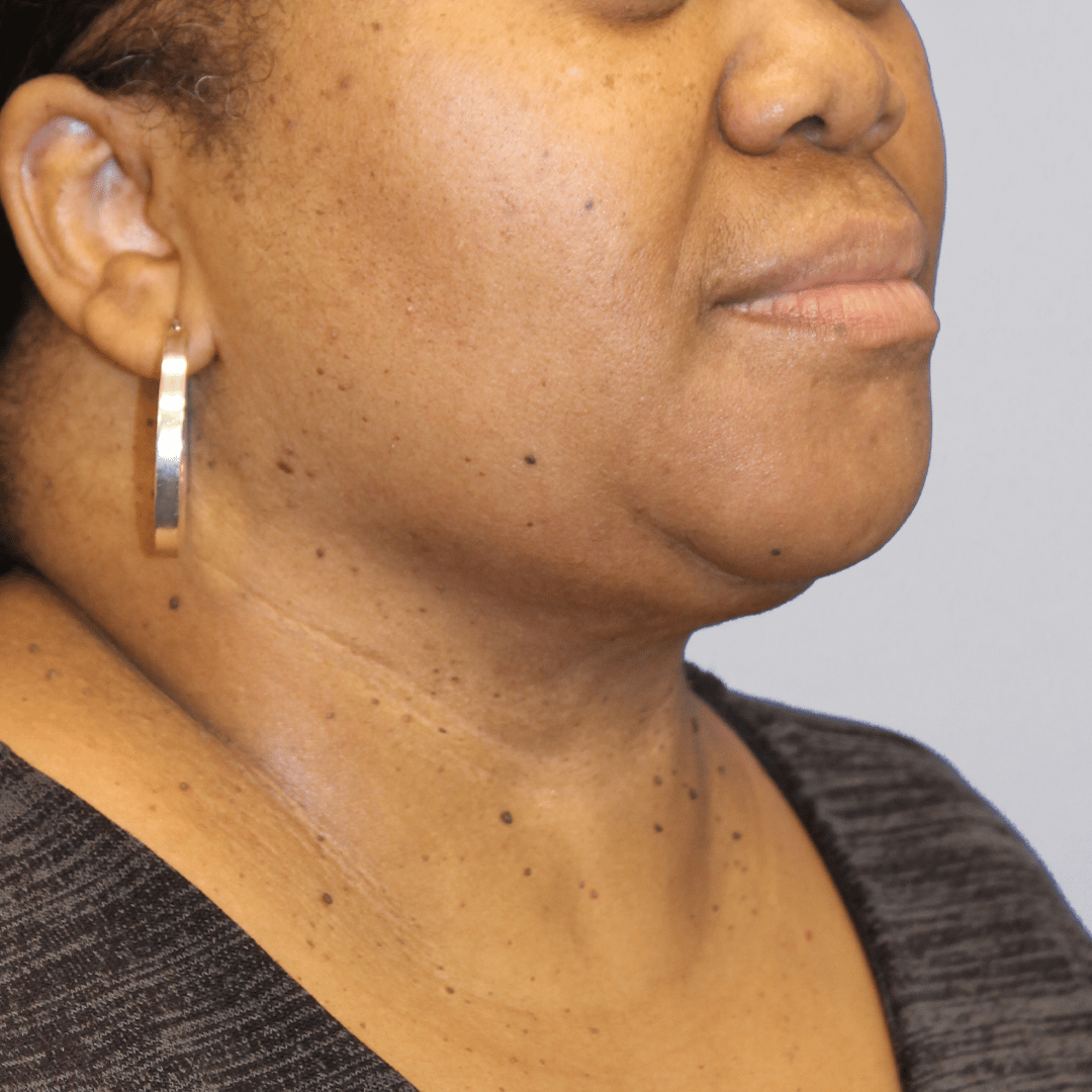 After Image:  - right-front-oblique
