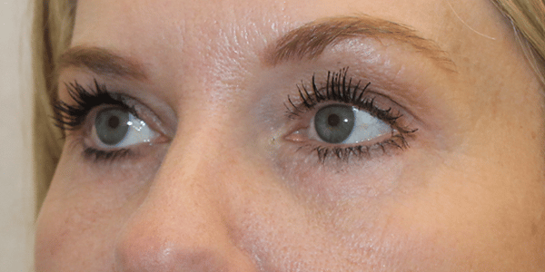 After Image:  - left-front-oblique