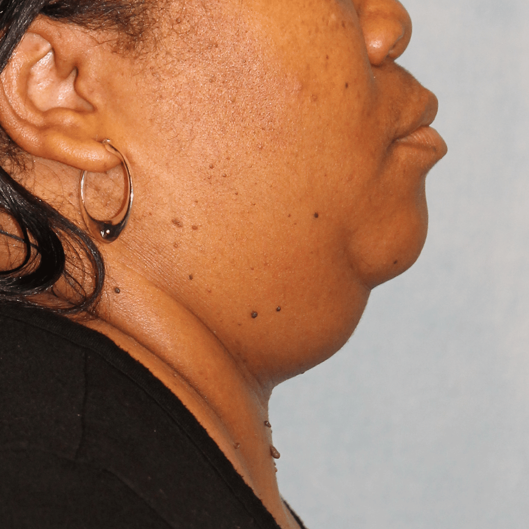 Before Image:  - right-side