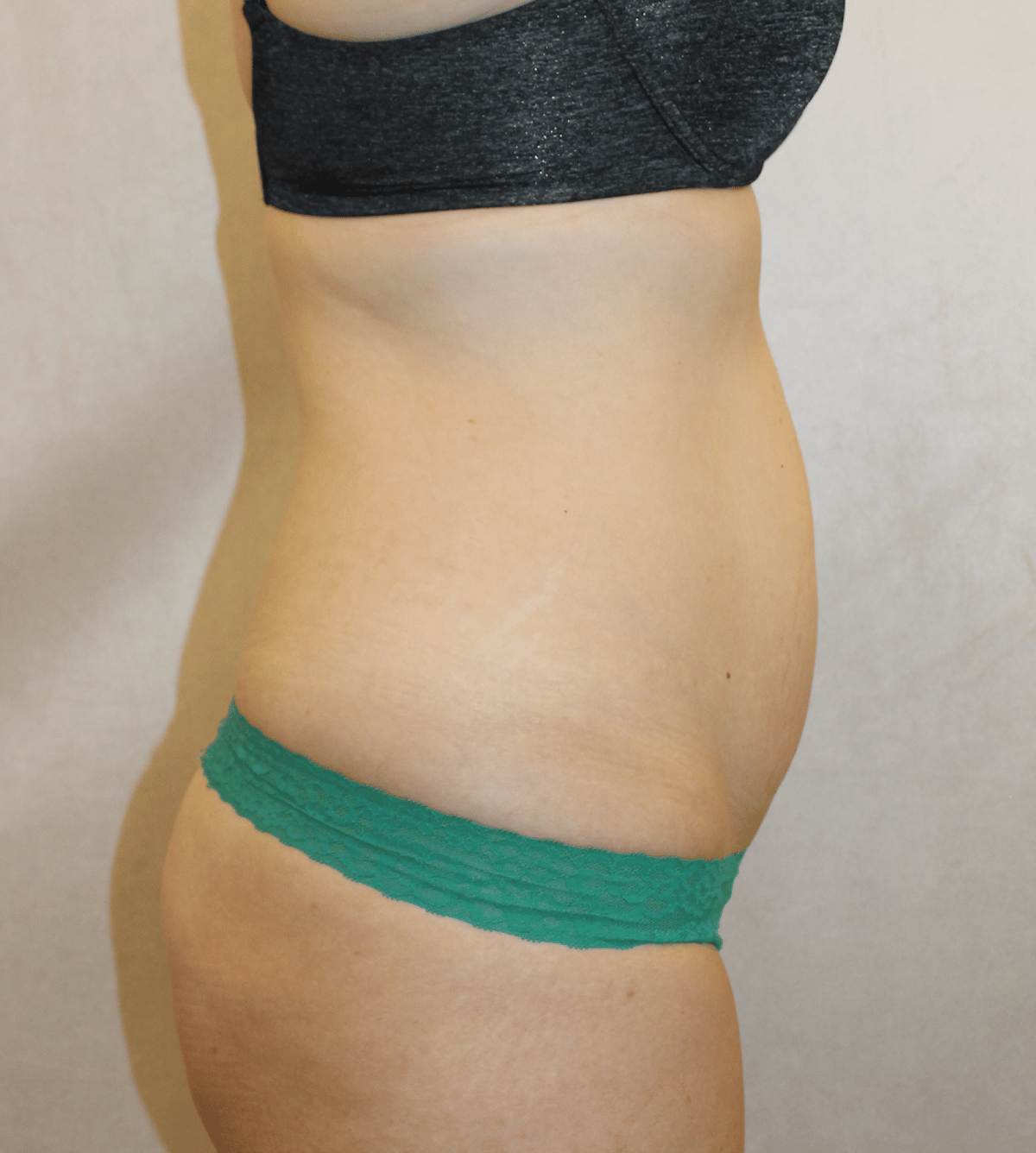 Before Image:  - right-side