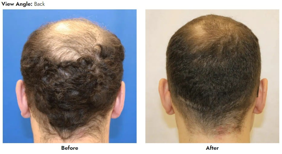 Hair Transplantation Gainesville, Florida | Hair Restoration Ocala, Florida  | Hair Transplant