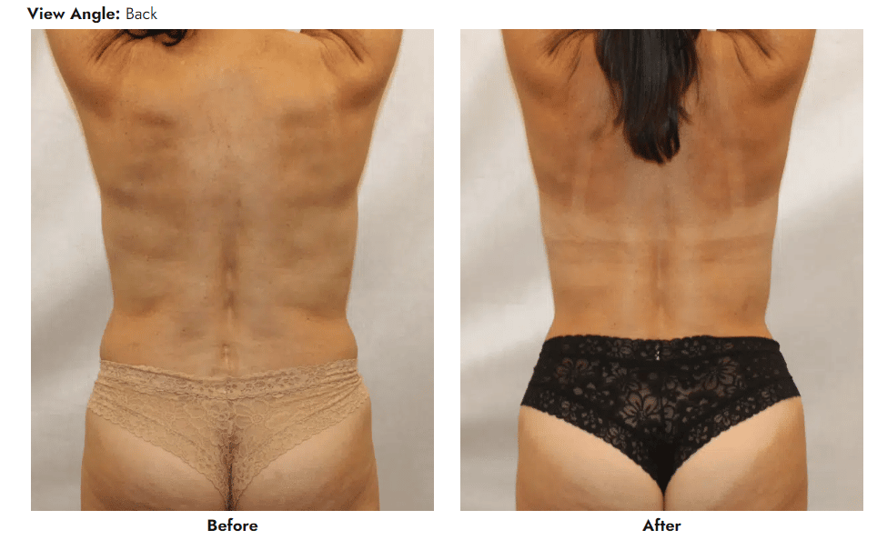 Bra Rolls Fat Removal Surgery - Gainesville Liposuction Specialist