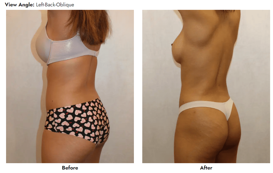 Best Liposuction Austin