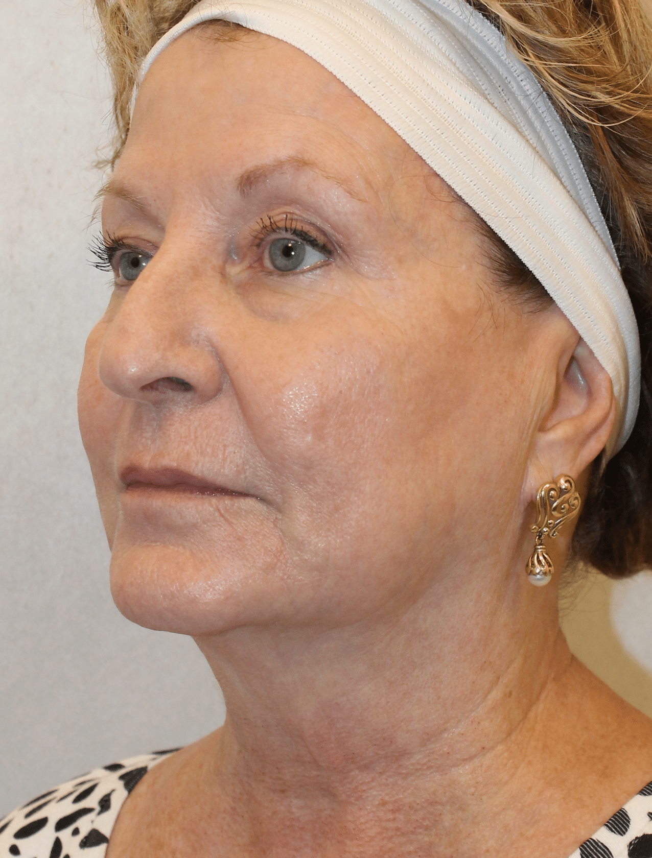 Before Image:  - left-front-oblique