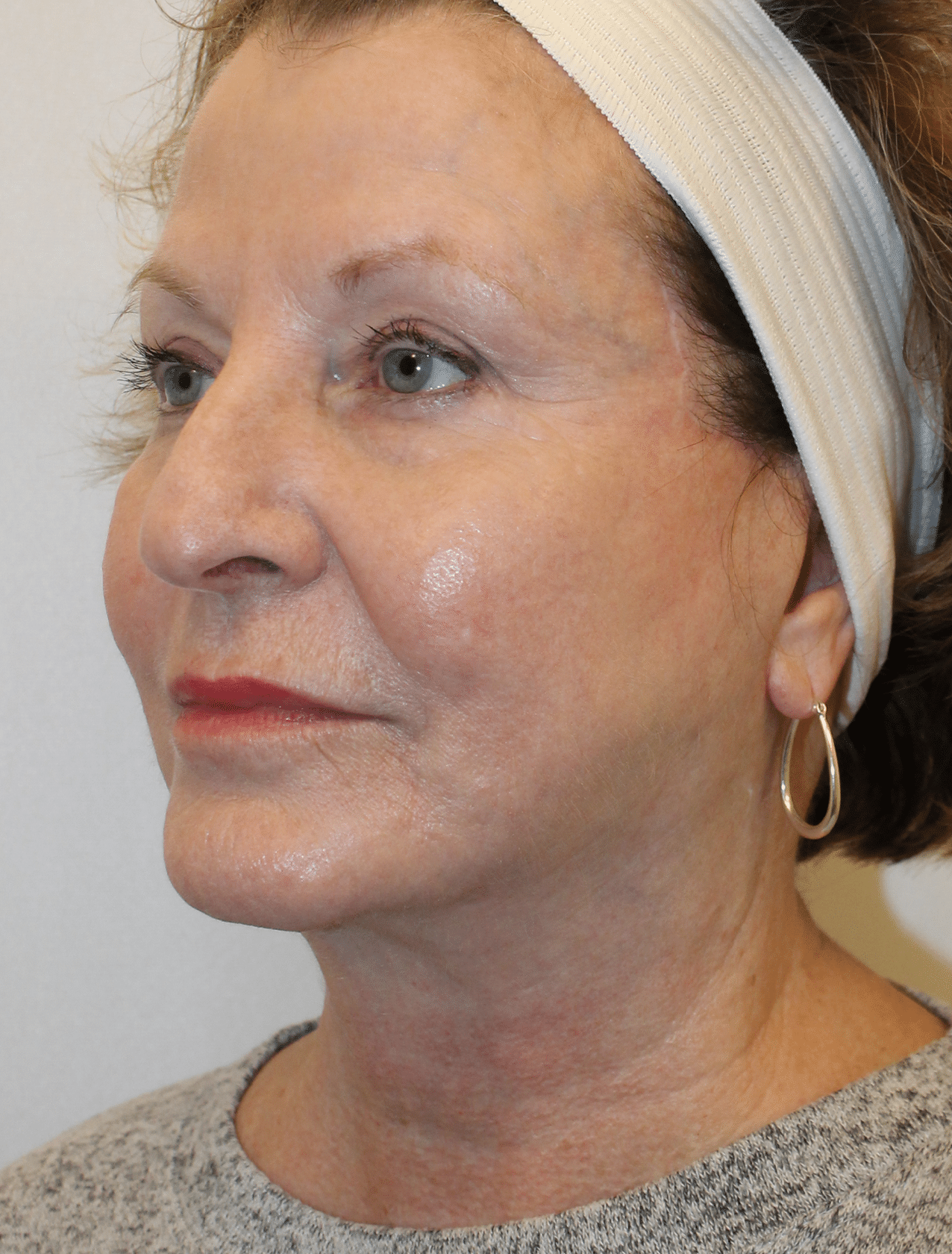 After Image:  - left-front-oblique