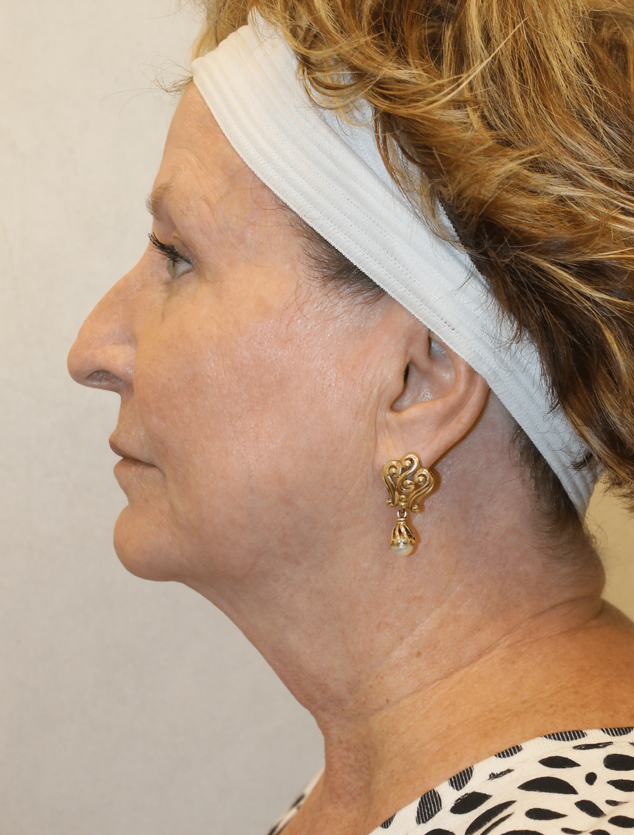 Before Image:  - left-side