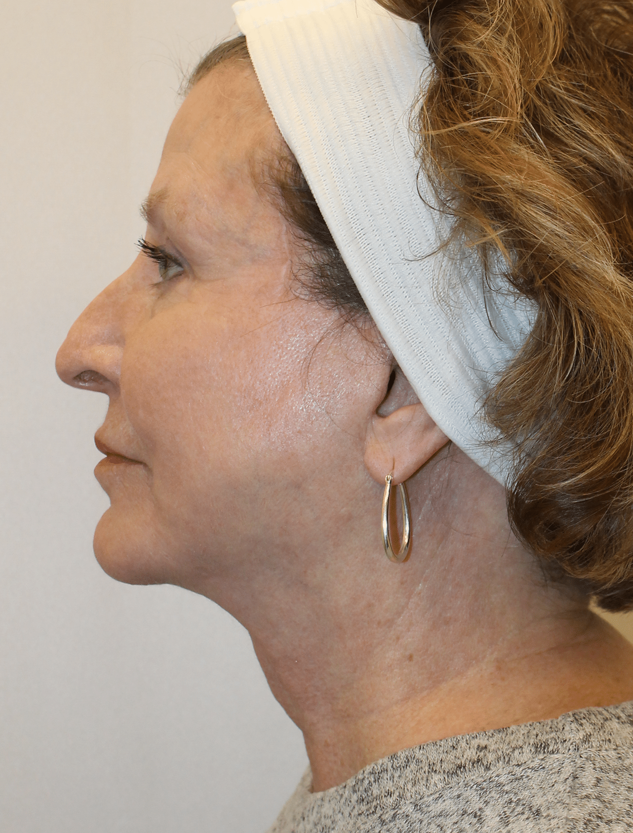 After Image:  - left-side