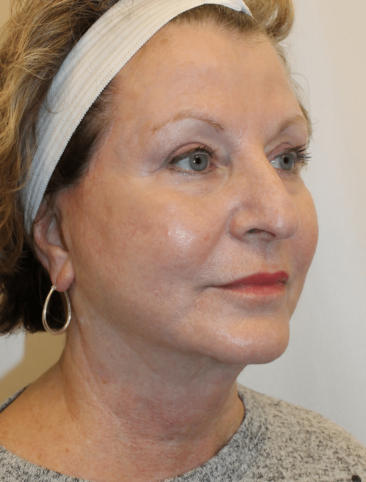 After Image:  - right-front-oblique