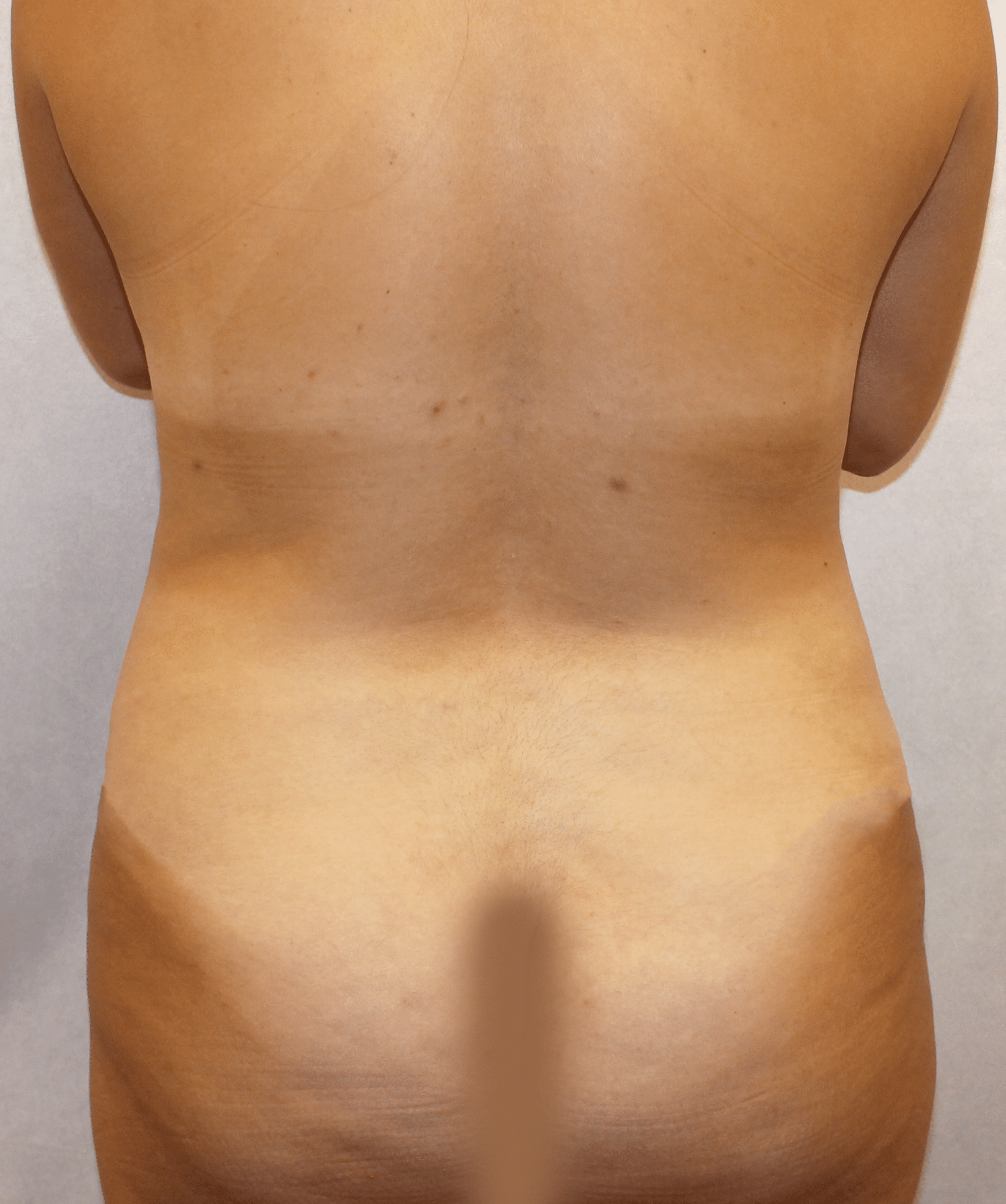 Before Image:  - back
