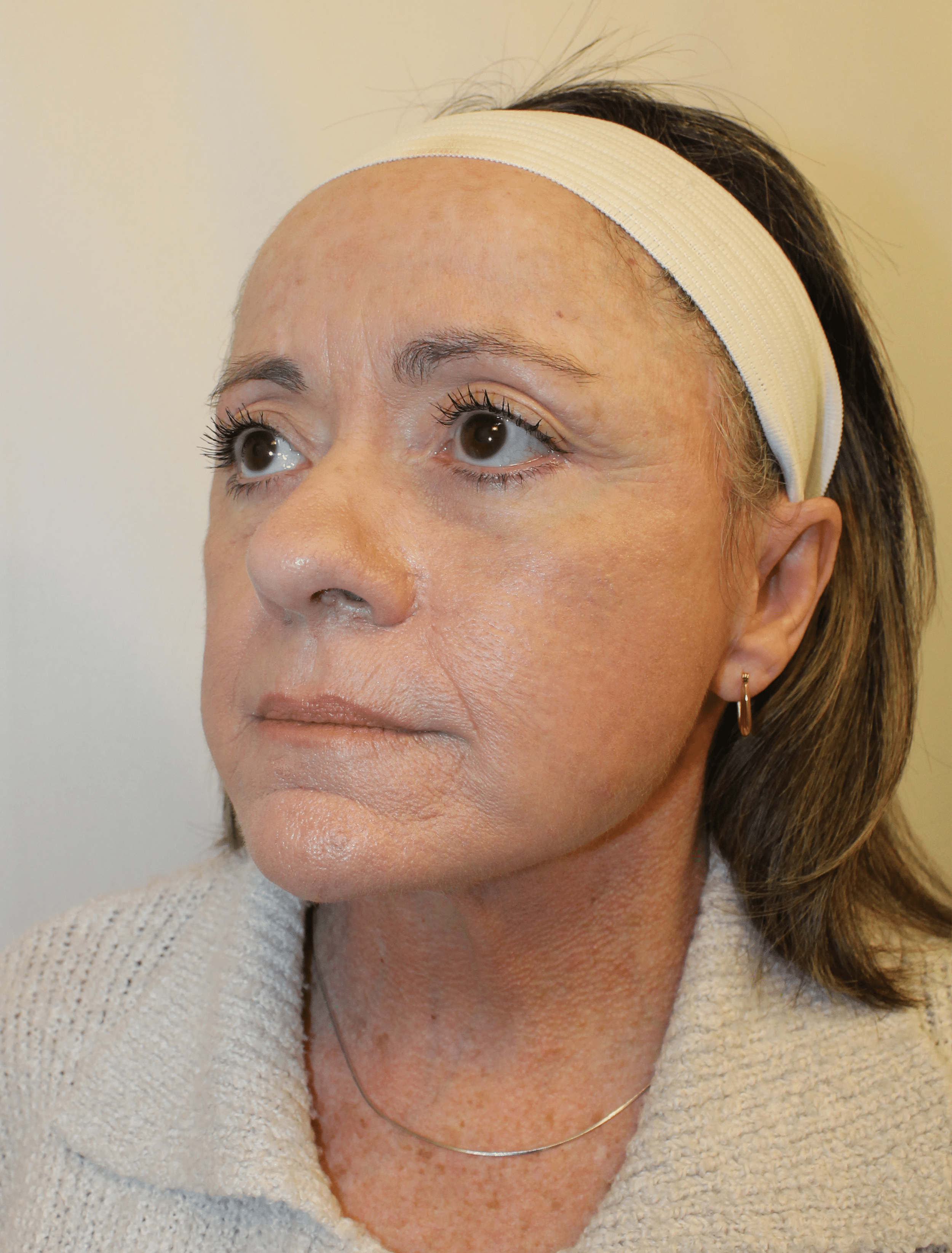 After Image:  - left-front-oblique