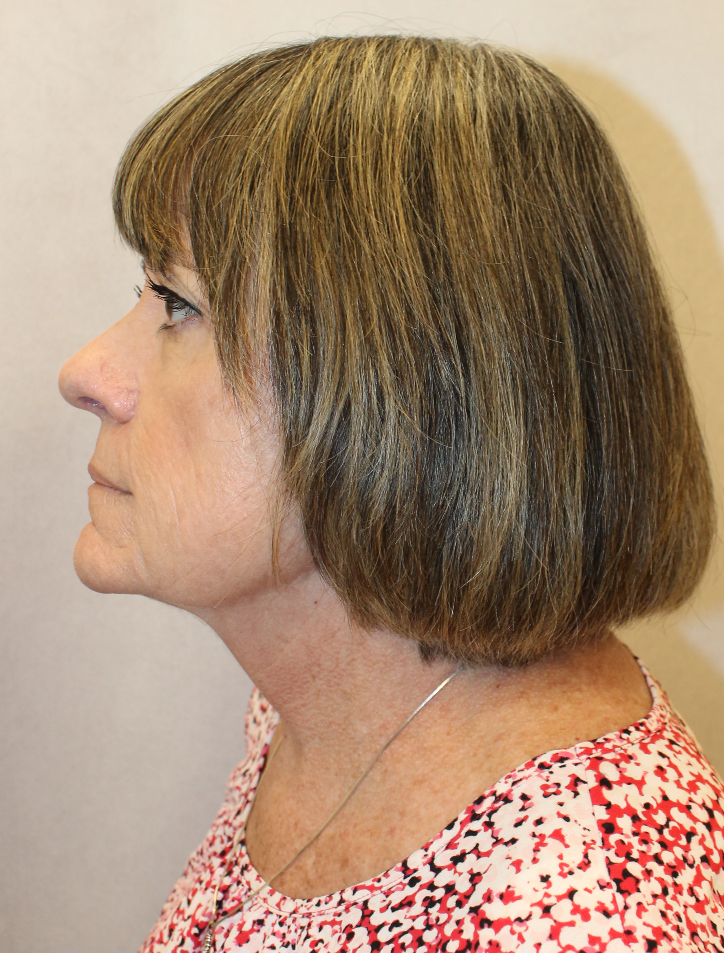 Before Image:  - left-side