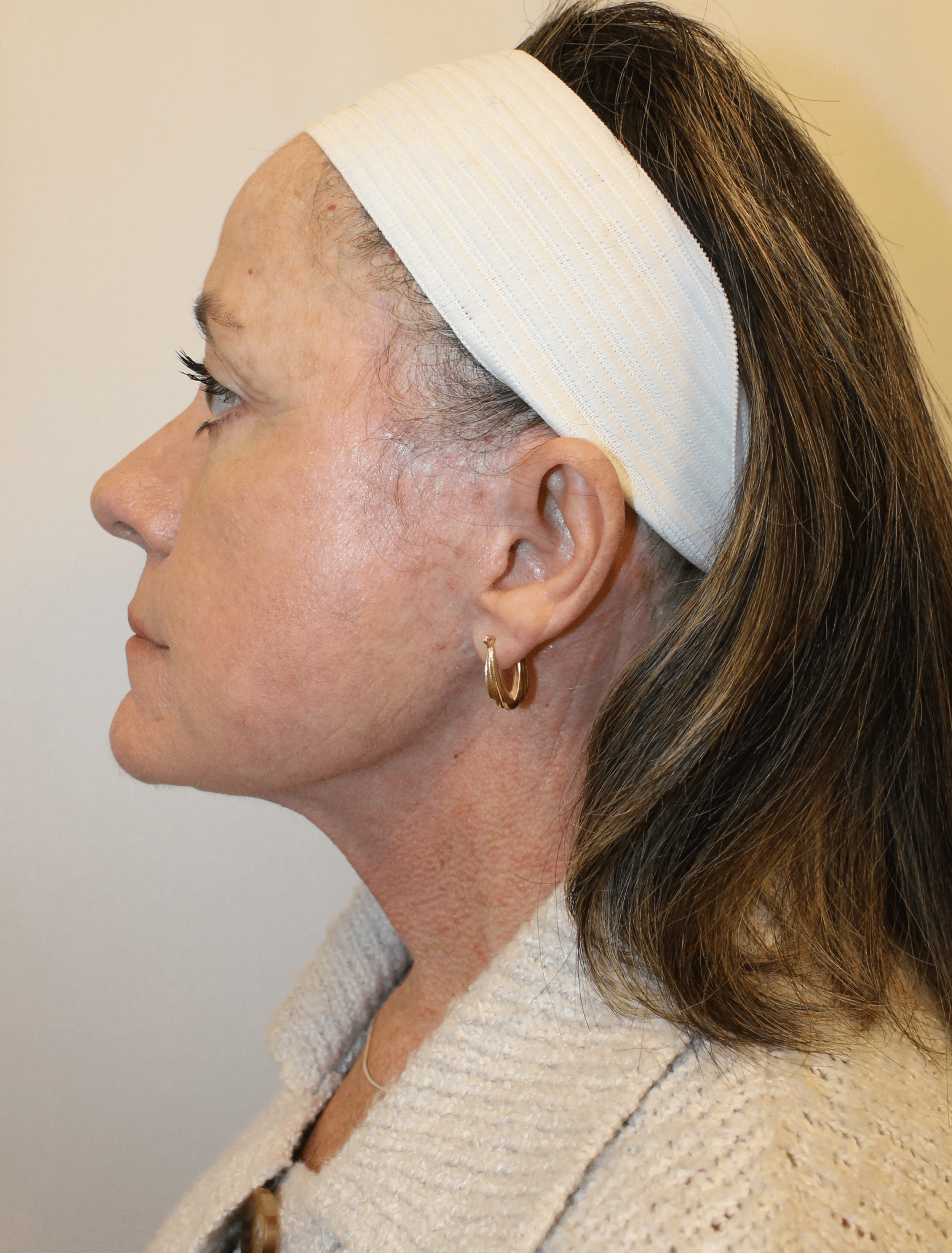 After Image:  - left-side
