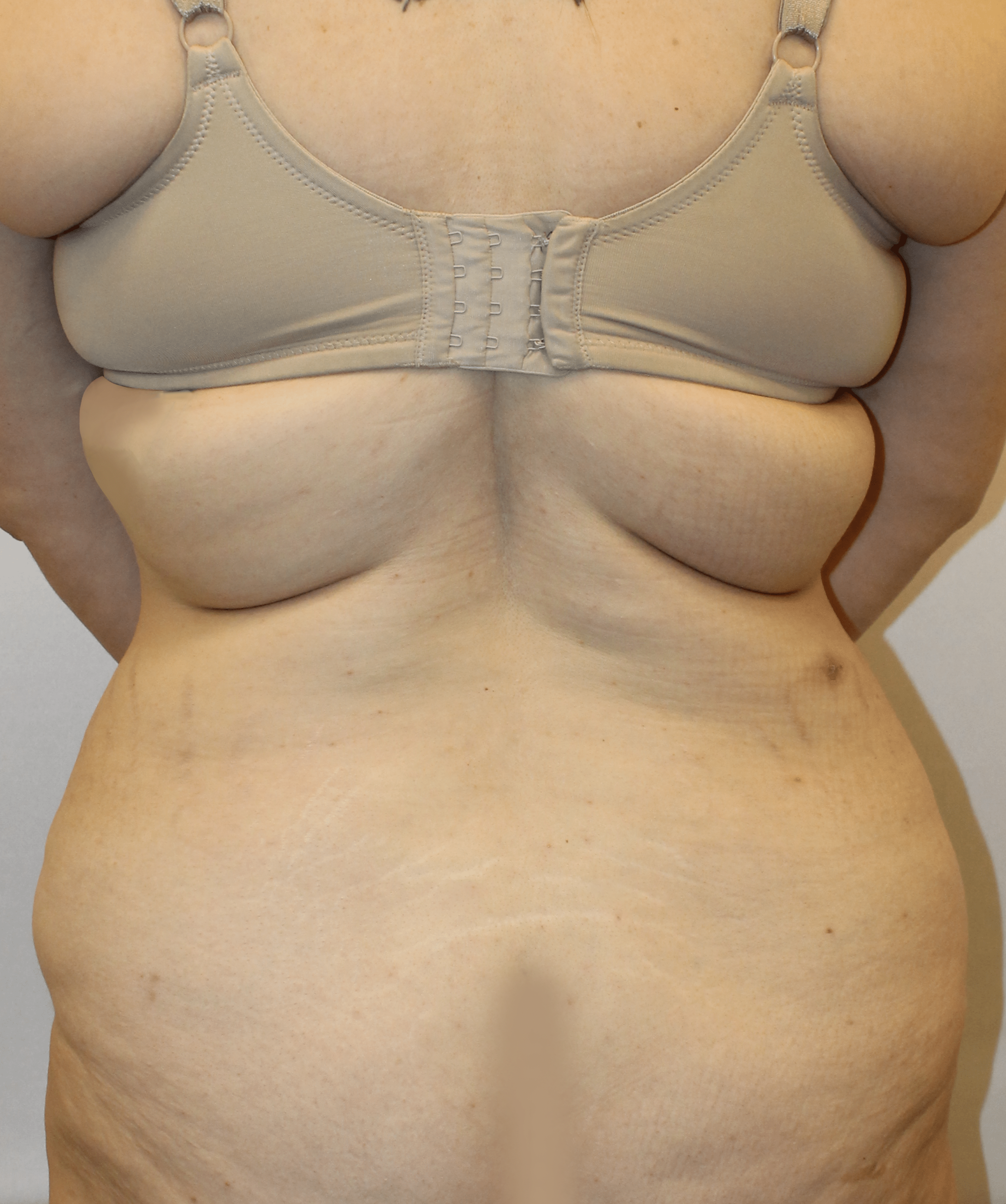 Before Image:  - back