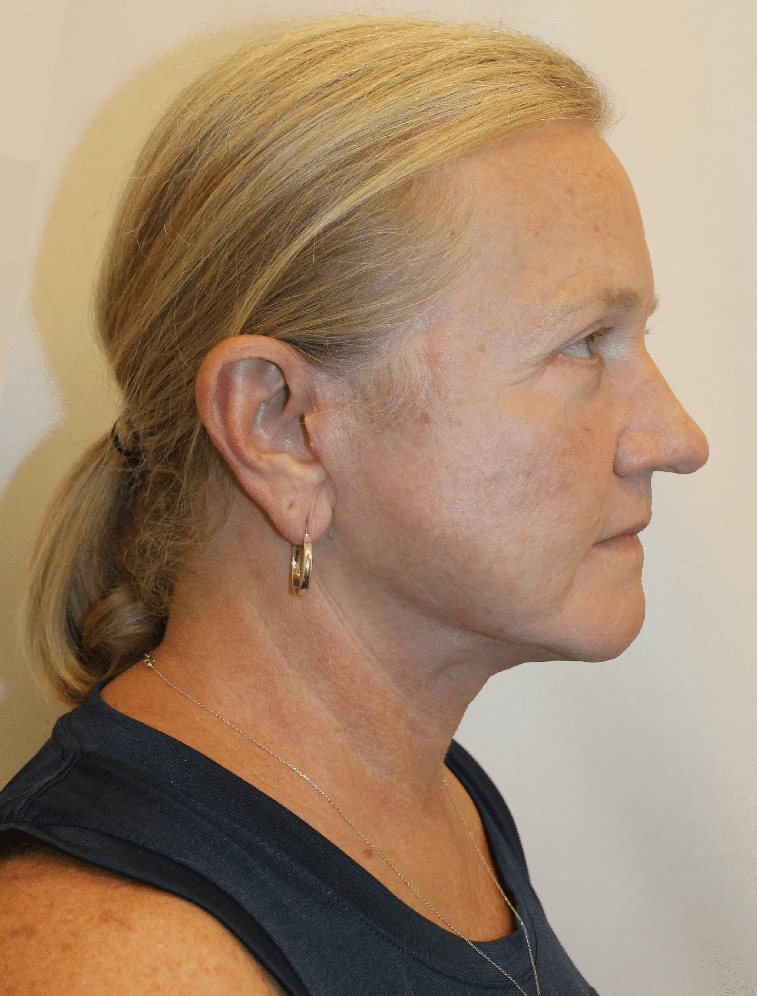 After Image:  - right-side