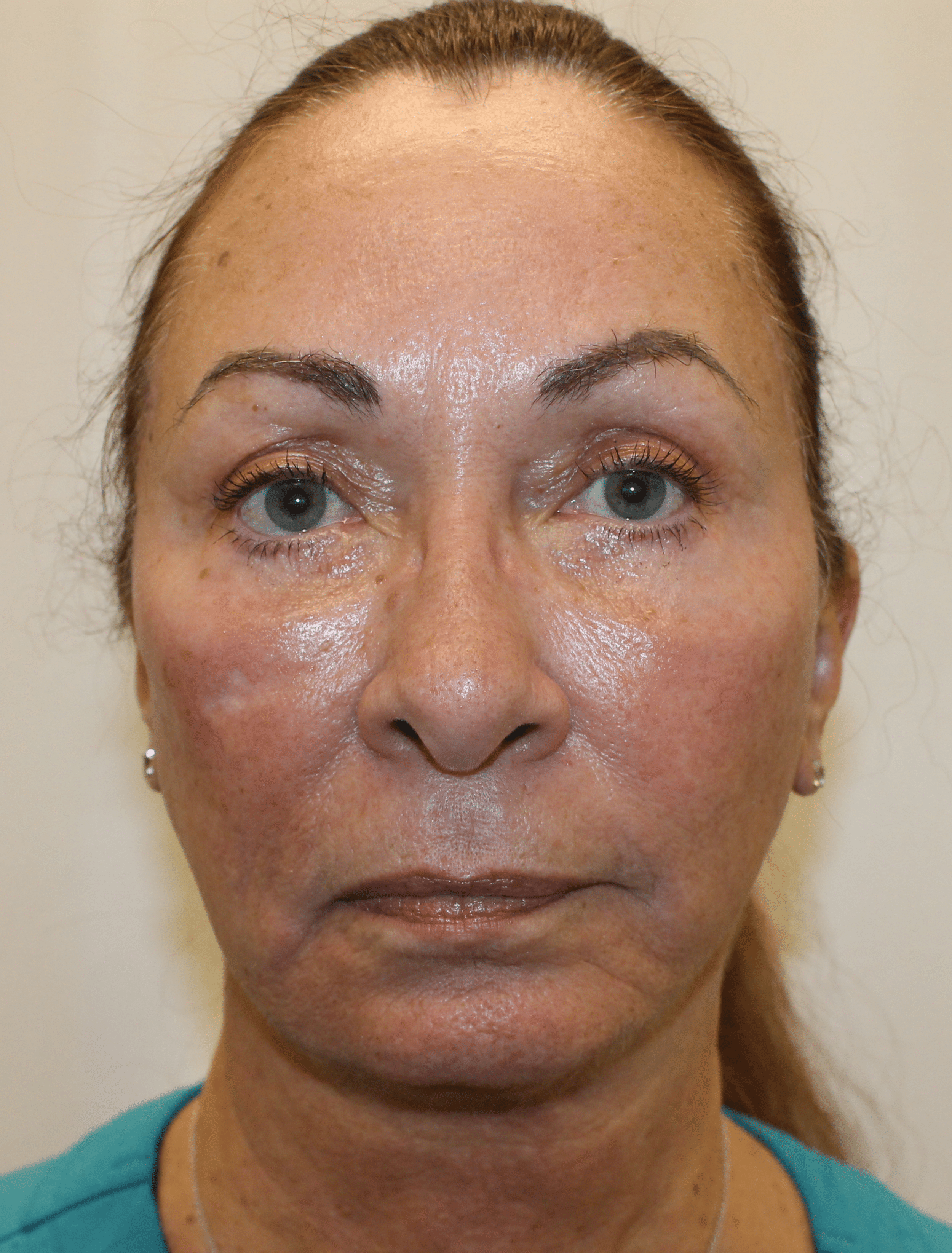 After Image:  - front