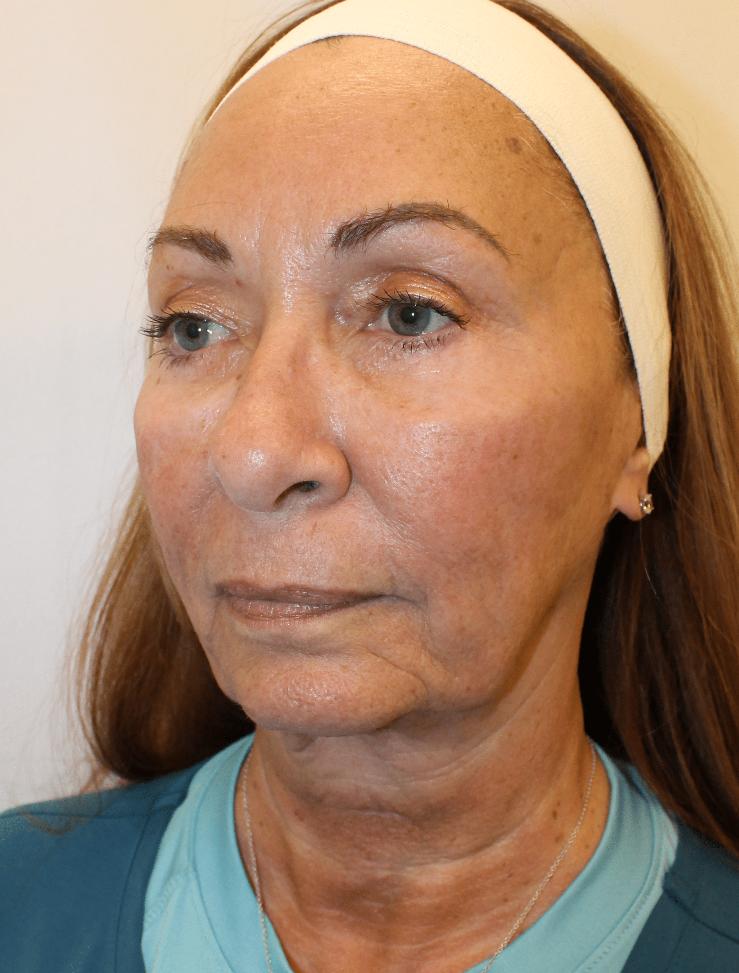 Before Image:  - left-front-oblique