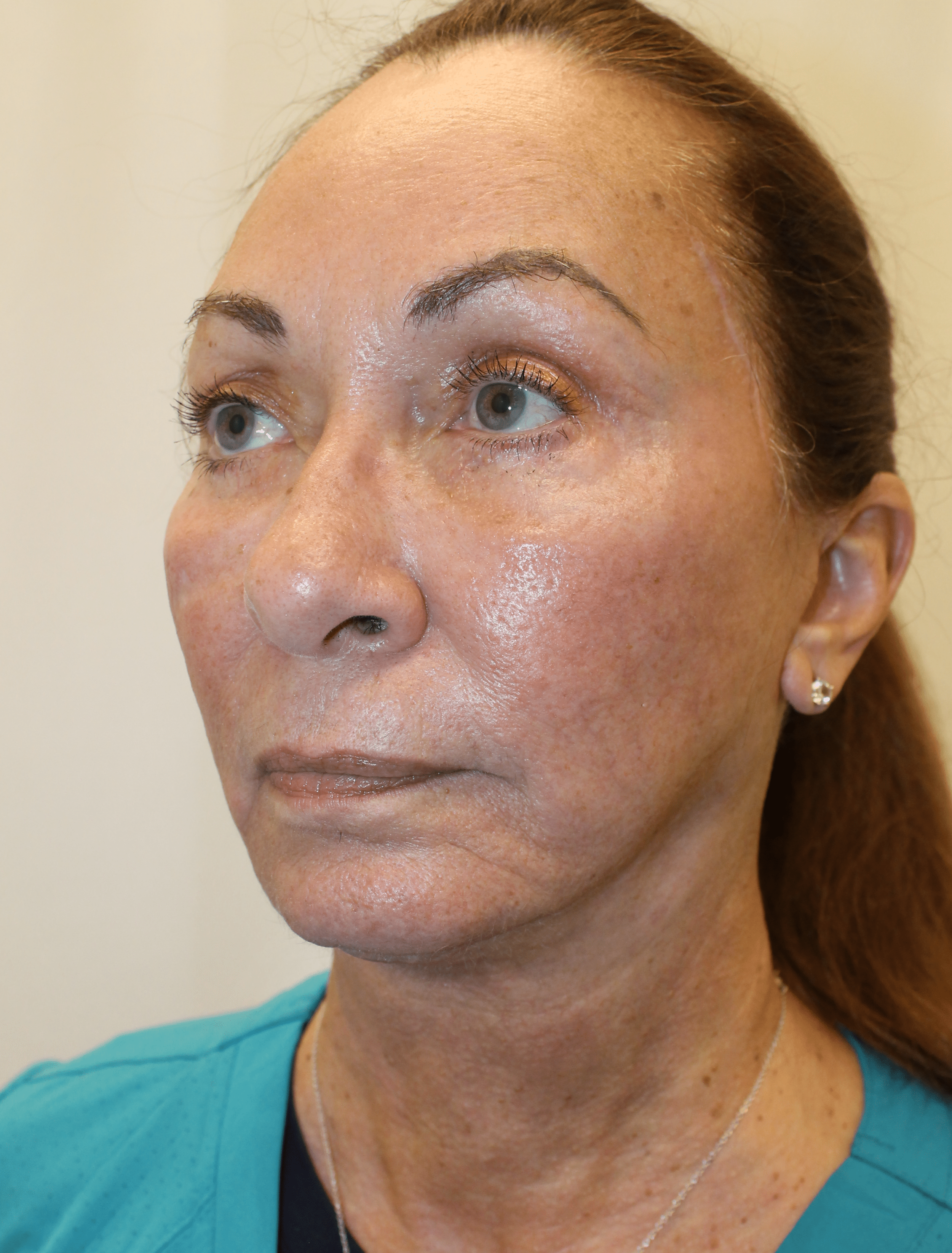 After Image:  - left-front-oblique