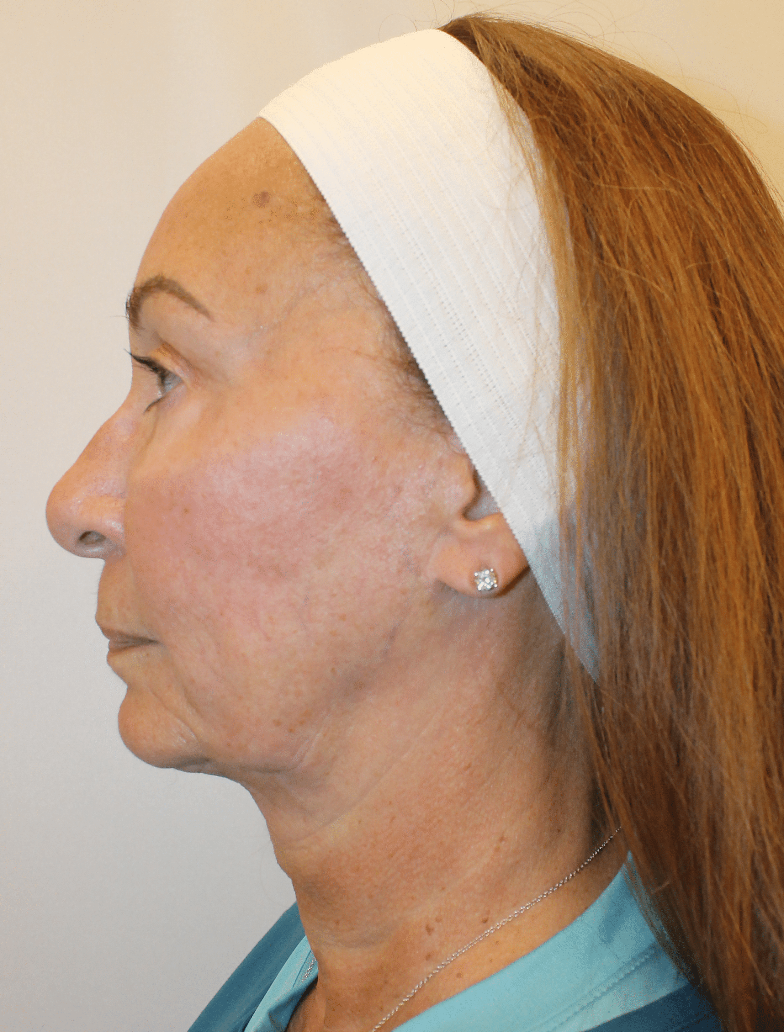 Before Image:  - left-side