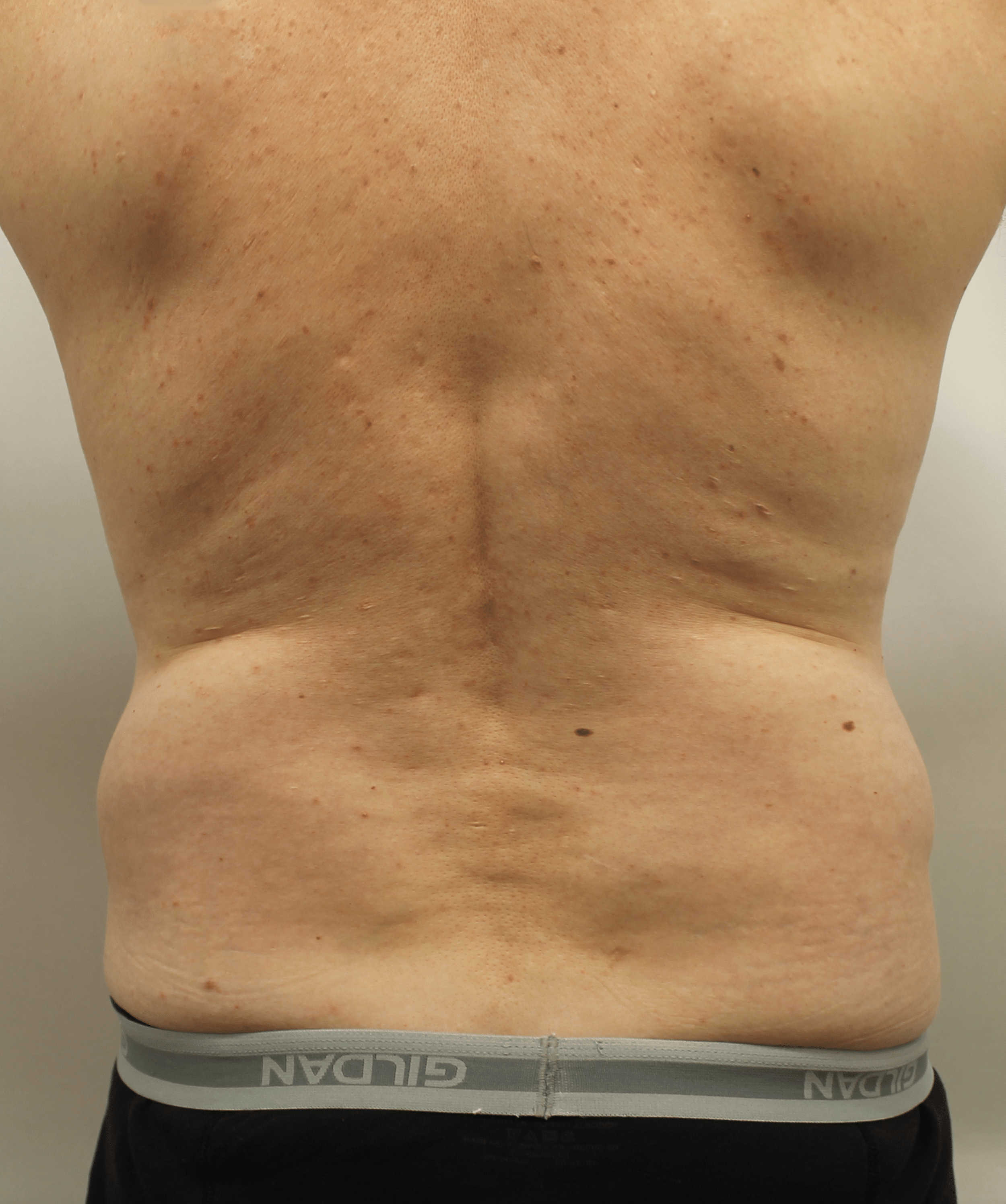 Before Image:  - back
