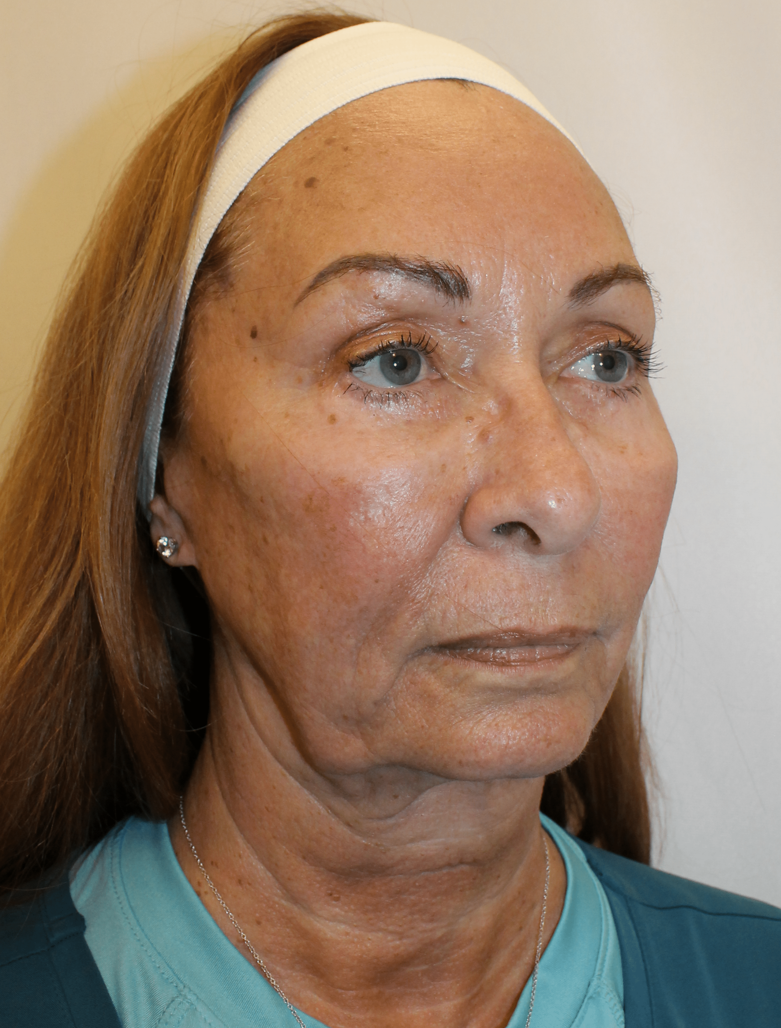Before Image:  - right-front-oblique
