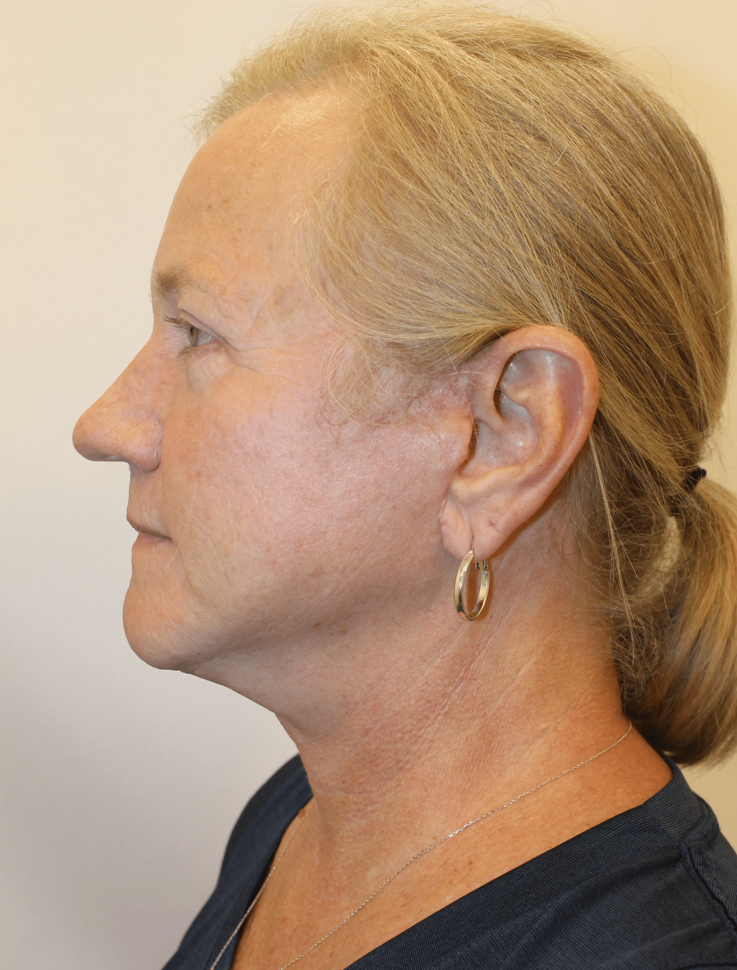 After Image:  - left-side