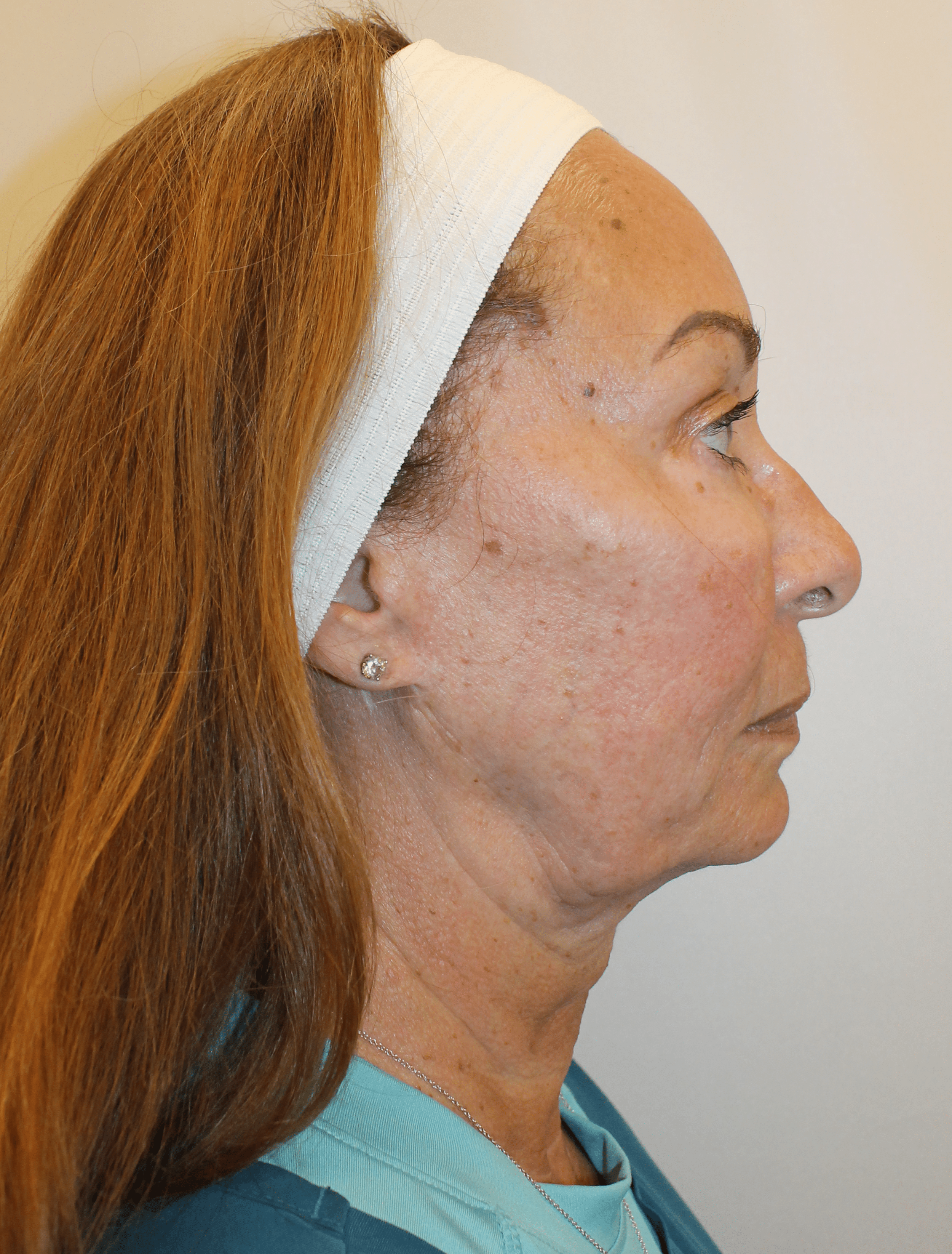 Before Image:  - right-side