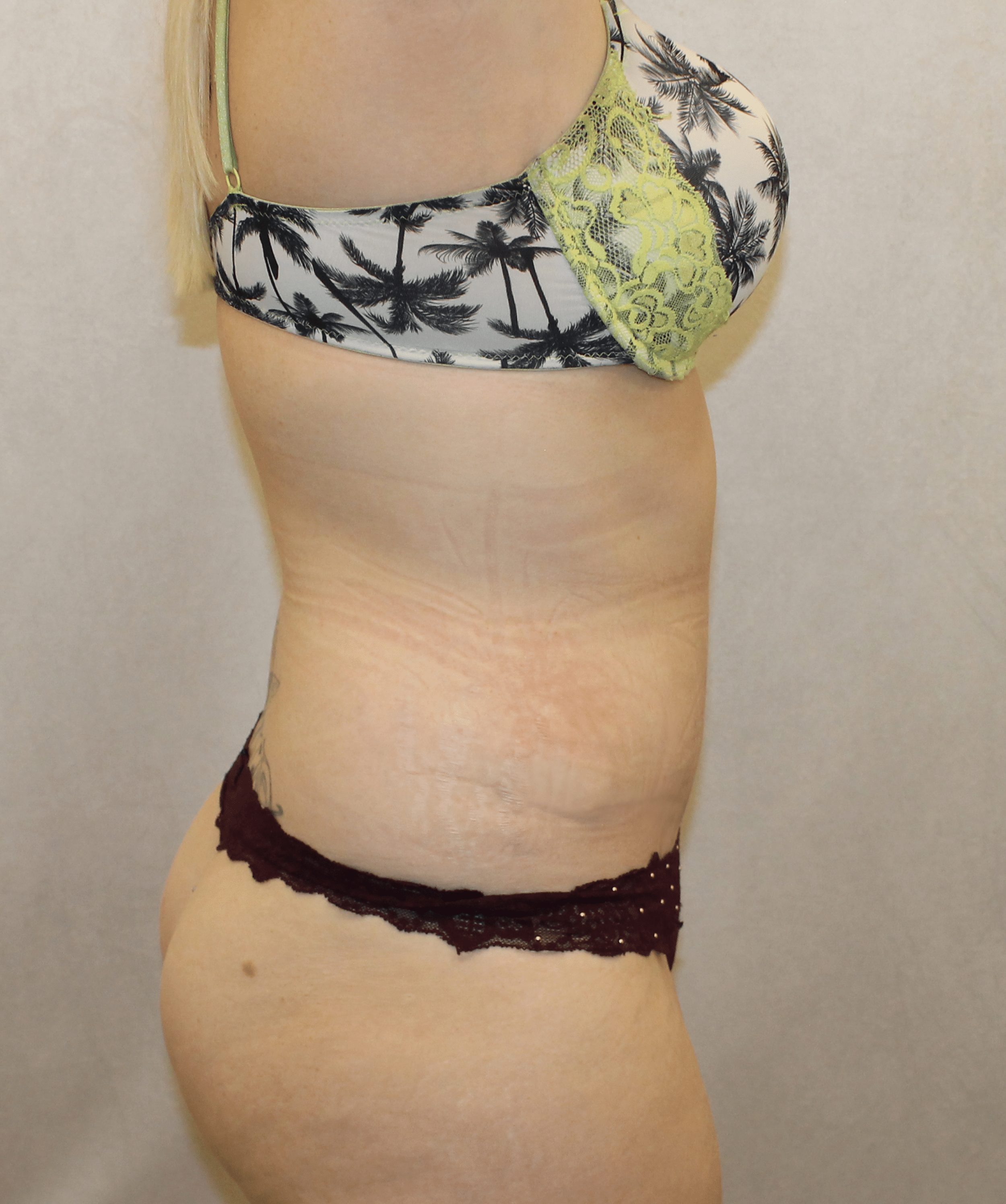 After Image:  - right-side