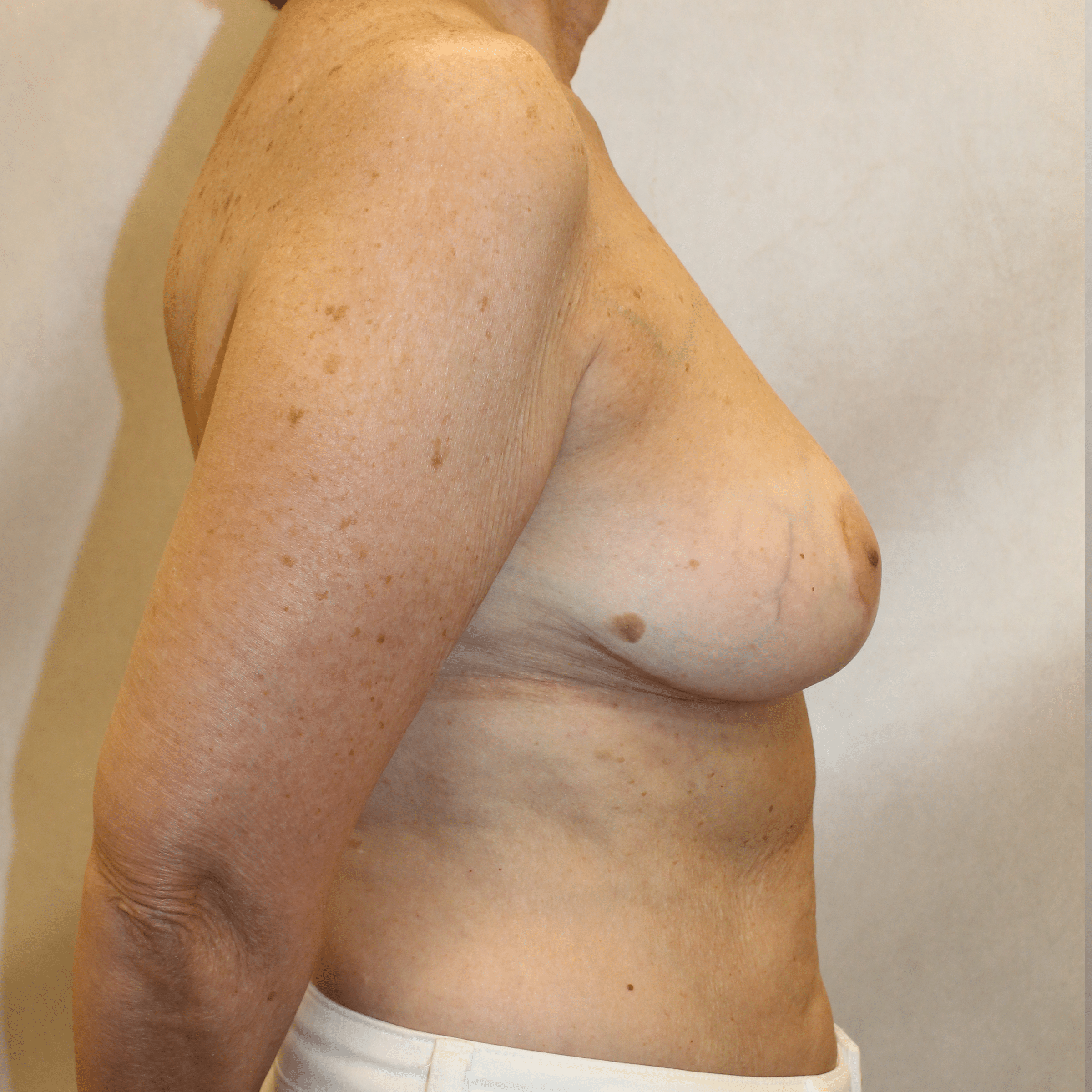After Image:  - right-side