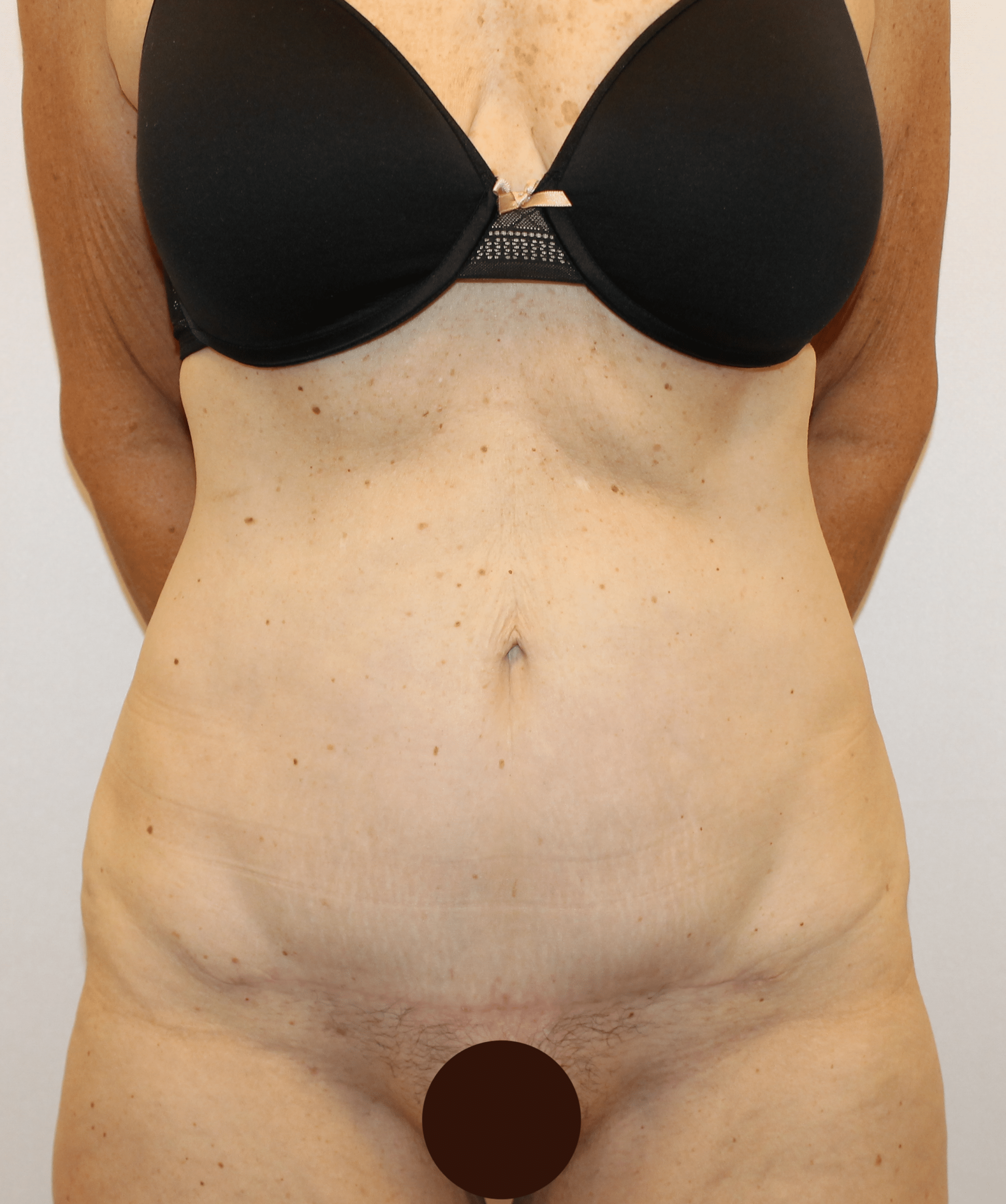After Image:  - front