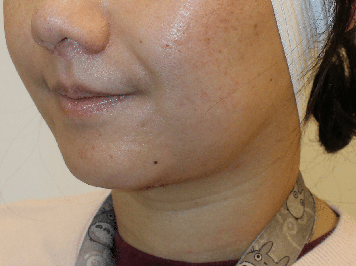 After Image:  - left-front-oblique