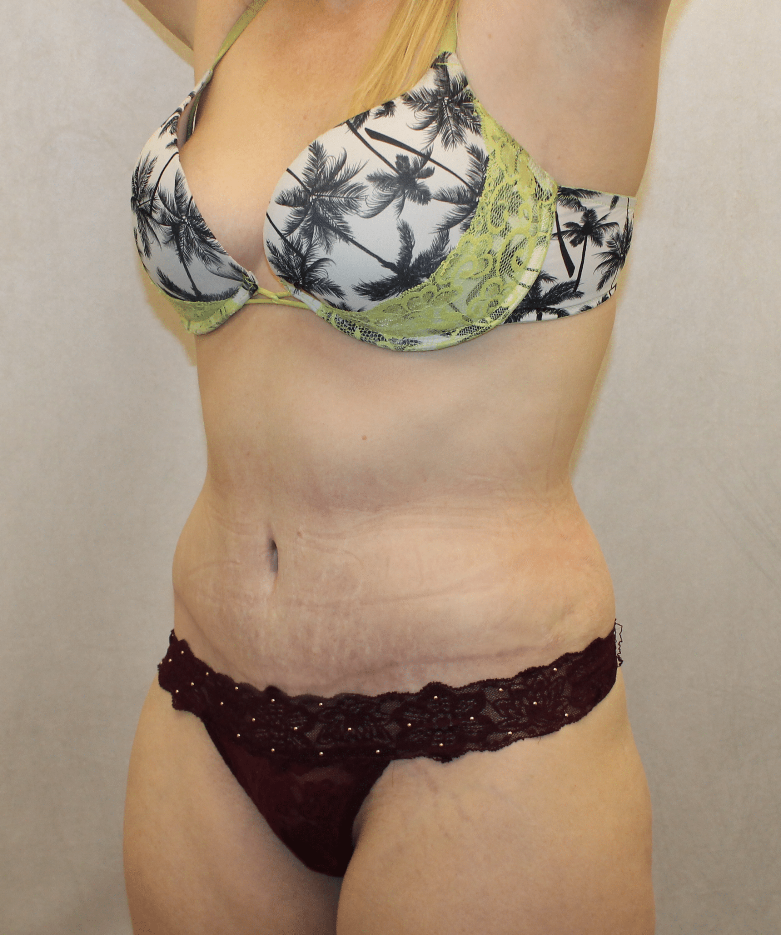 After Image:  - left-front-oblique